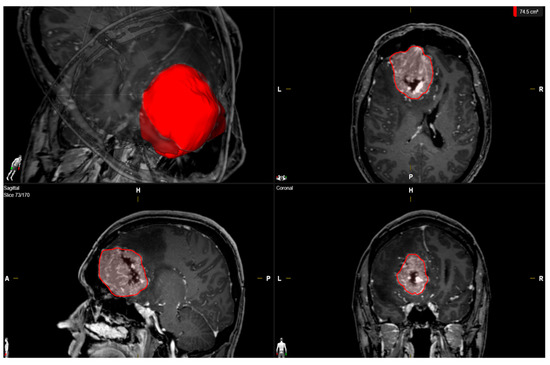 Inflammatory Tumor Microenvironment in Cranial Meningiomas