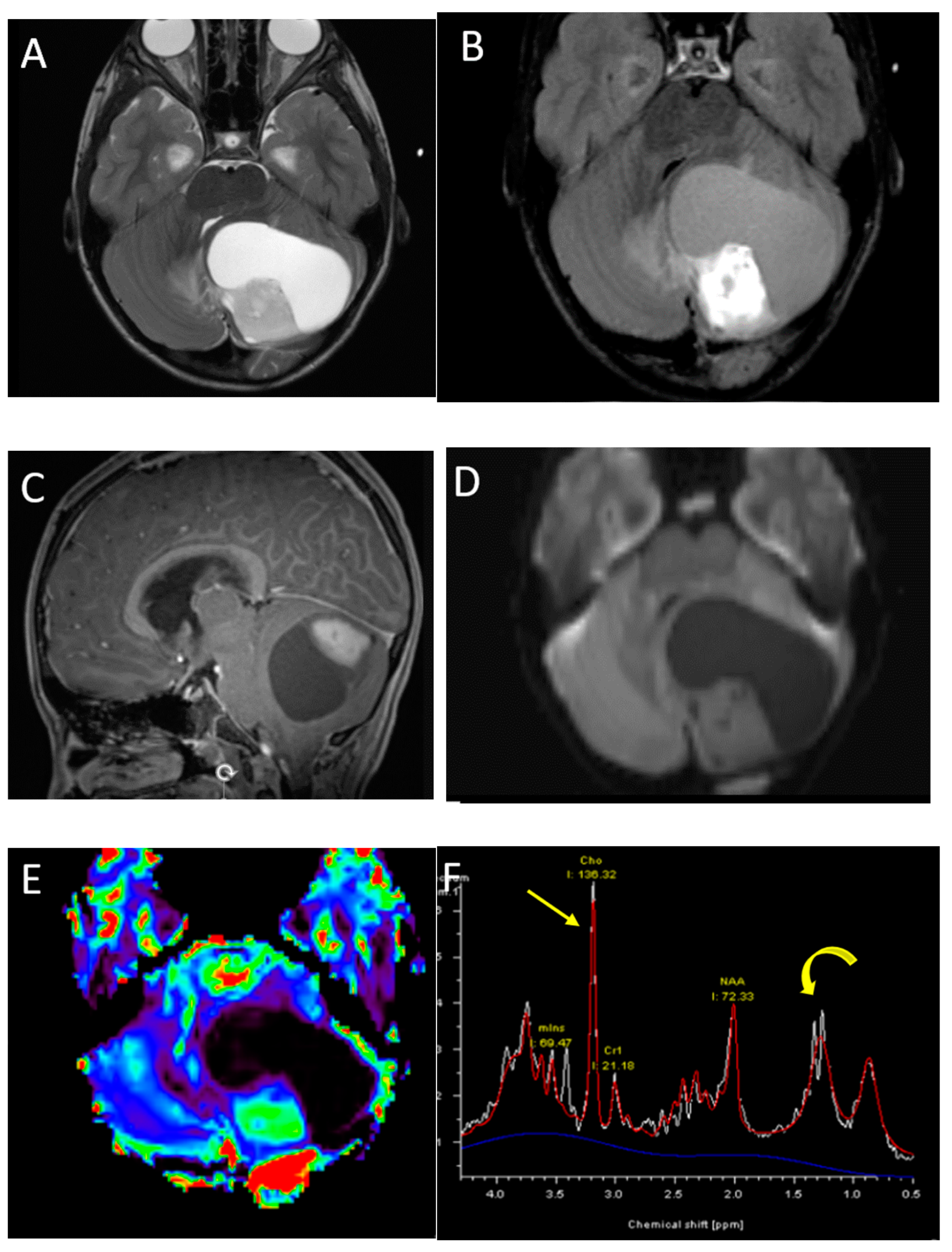 orr papilloma ct