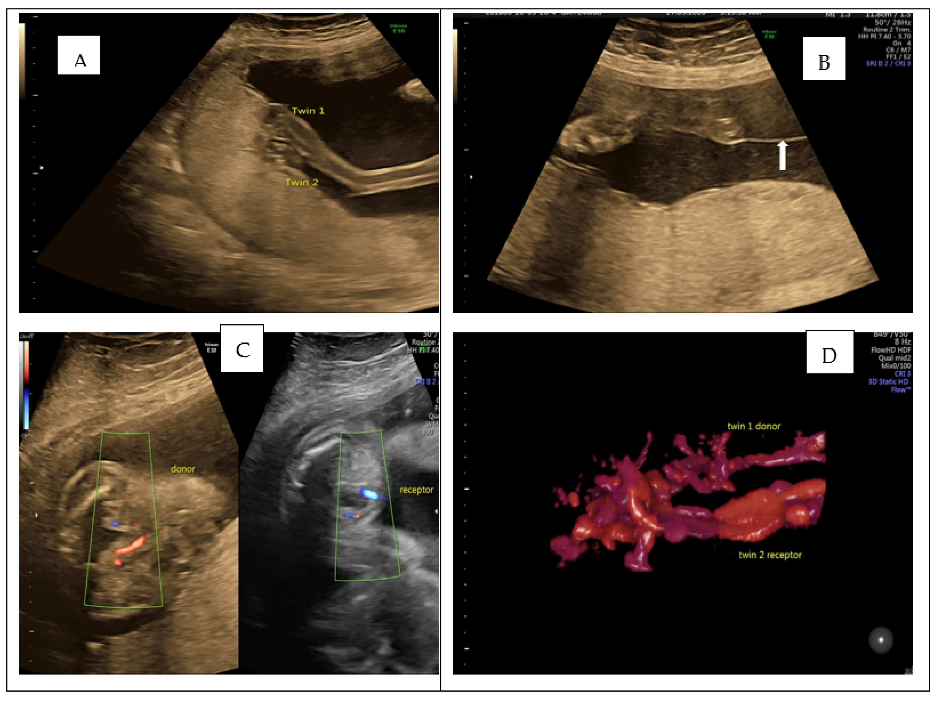 Monochorionic Diamniotic Twins Identical