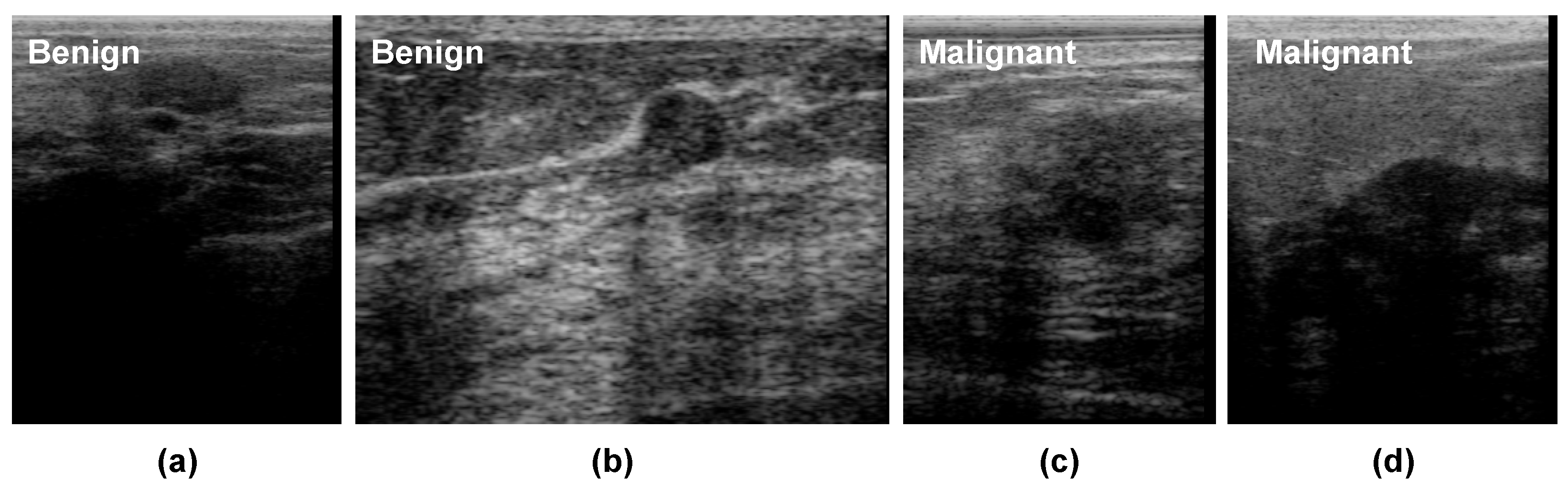 Predicting Breast Tumor Malignancy Using Deep ConvNeXt