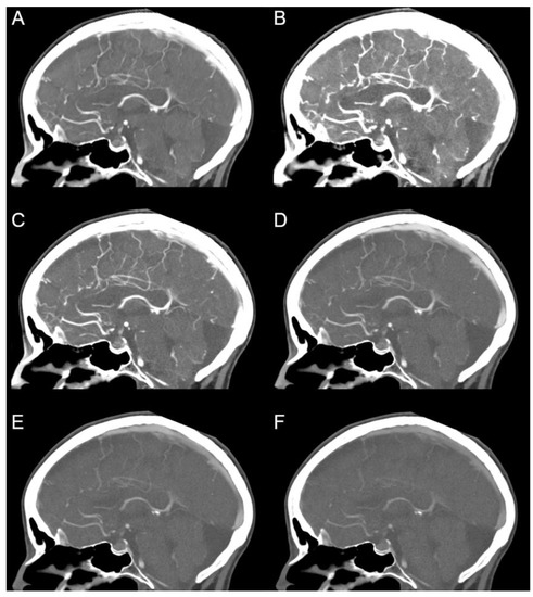 Photon Counting CT Angiography of the Head and Neck: Image Quality 