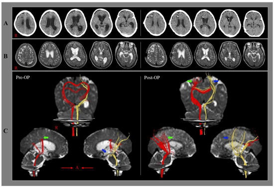 Diffusion Tensor Imaging 洋書 Frontiers | Diffusion Tensor Imaging Along the Perivascular