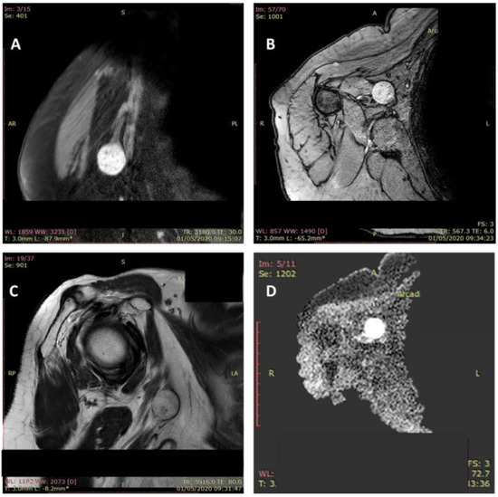 Diagnostics Free Full Text Schwannoma of the Upper Limb