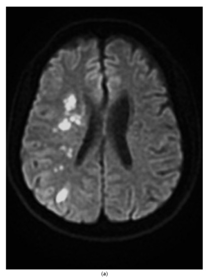 Border-Zone Infarction Due to Cerebrovascular Fibromuscular Dysplasia