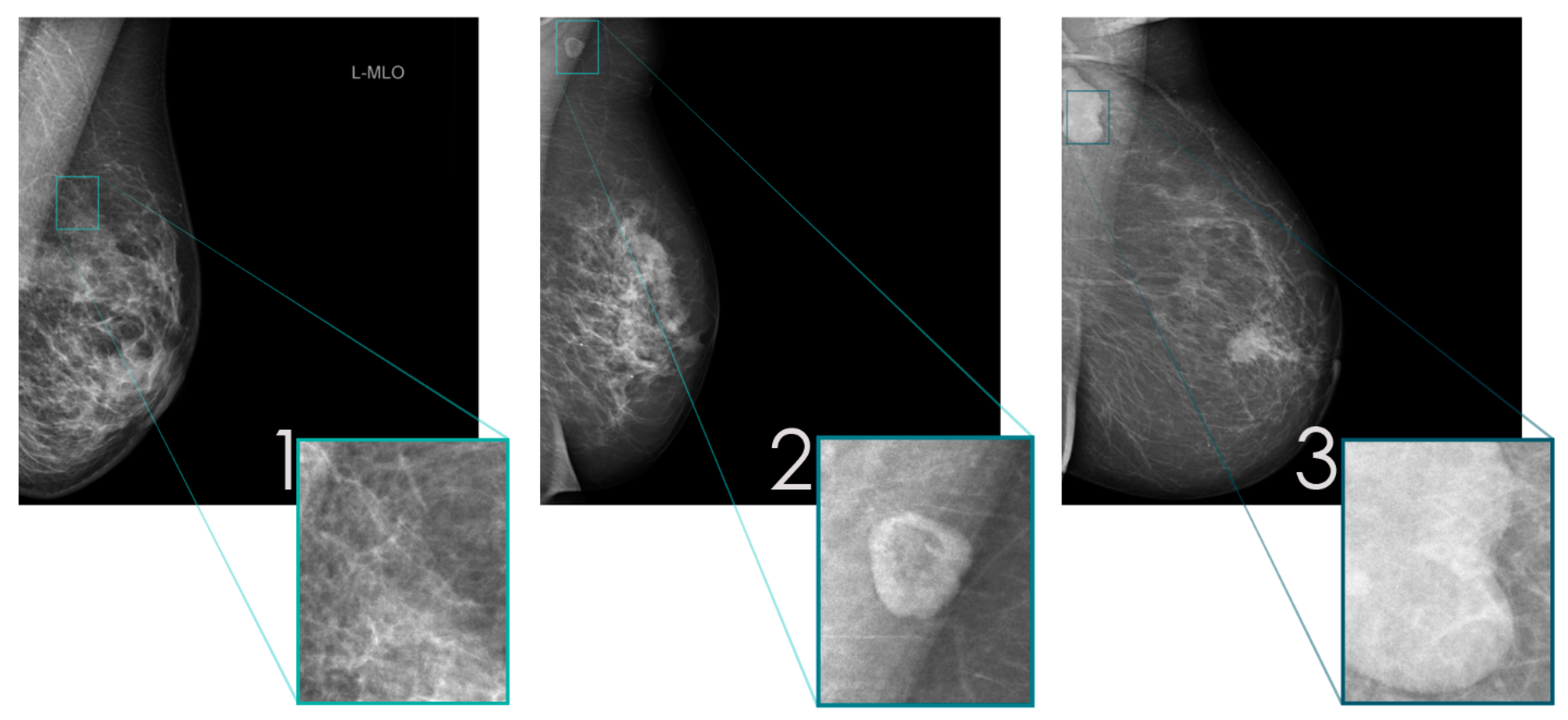 diagnostics-free-full-text-detecting-abnormal-axillary-lymph-nodes