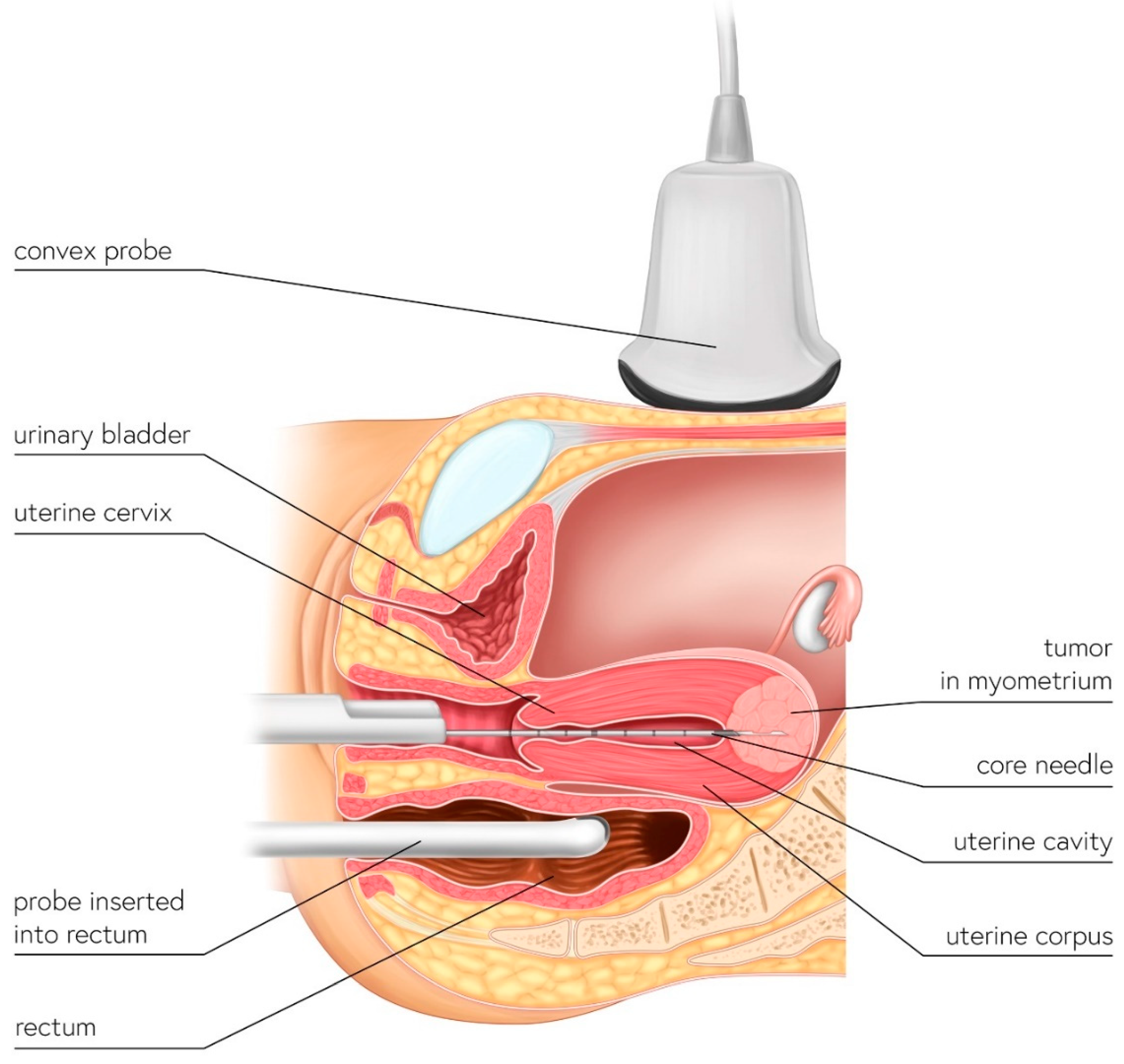 Ultrasound-Guided Trans-Uterine Cavity Core Needle Biopsy of 
