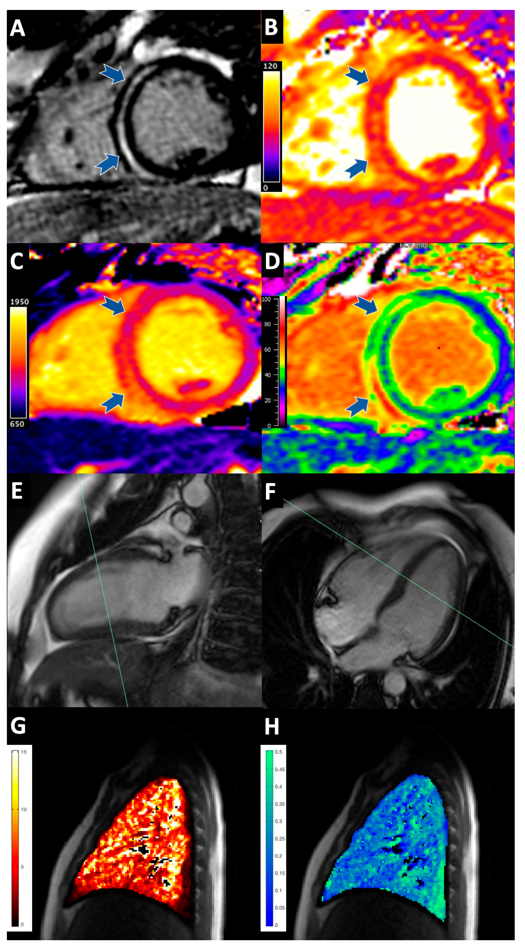 Diagnostics | Free Full-Text | Acute and Chronic Cardiopulmonary Effects of  High Dose Interleukin-2 Therapy: An Observational Magnetic Resonance  Imaging Study