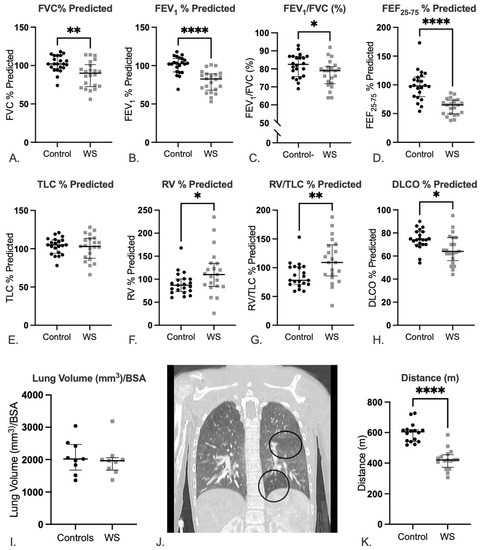 Airflow Obstruction in Adults with Williams Syndrome and