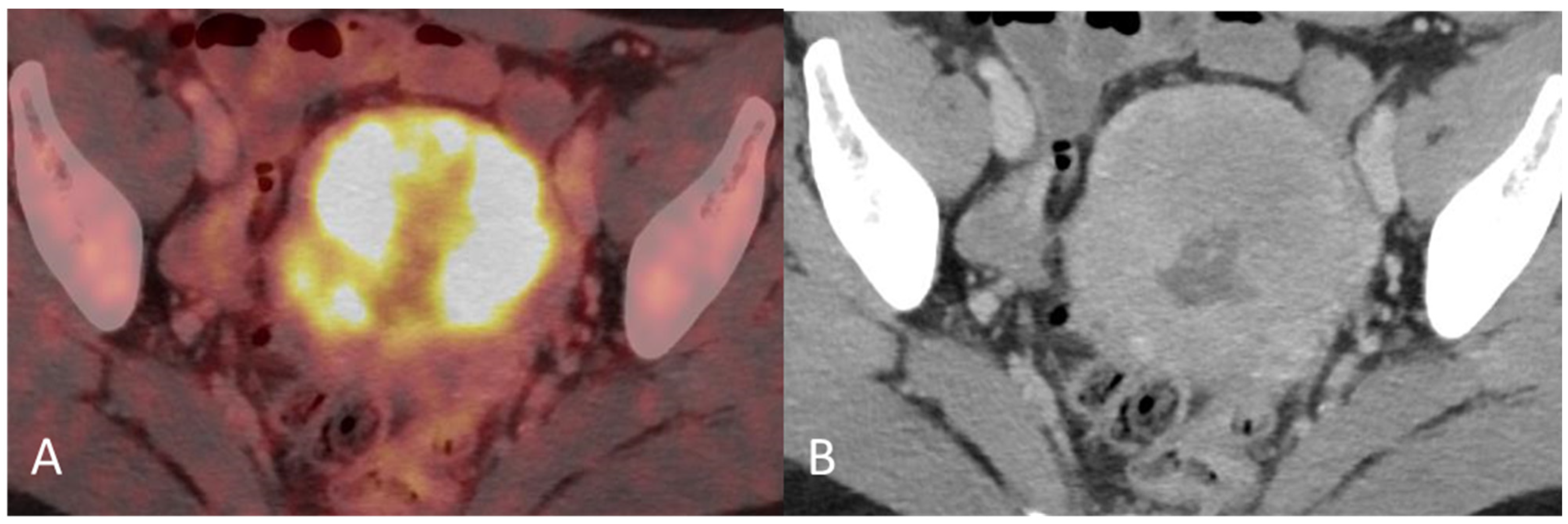 Disseminated Primary Uterine Hepatoid Adenocarcinoma with α-Fetoprotein ...