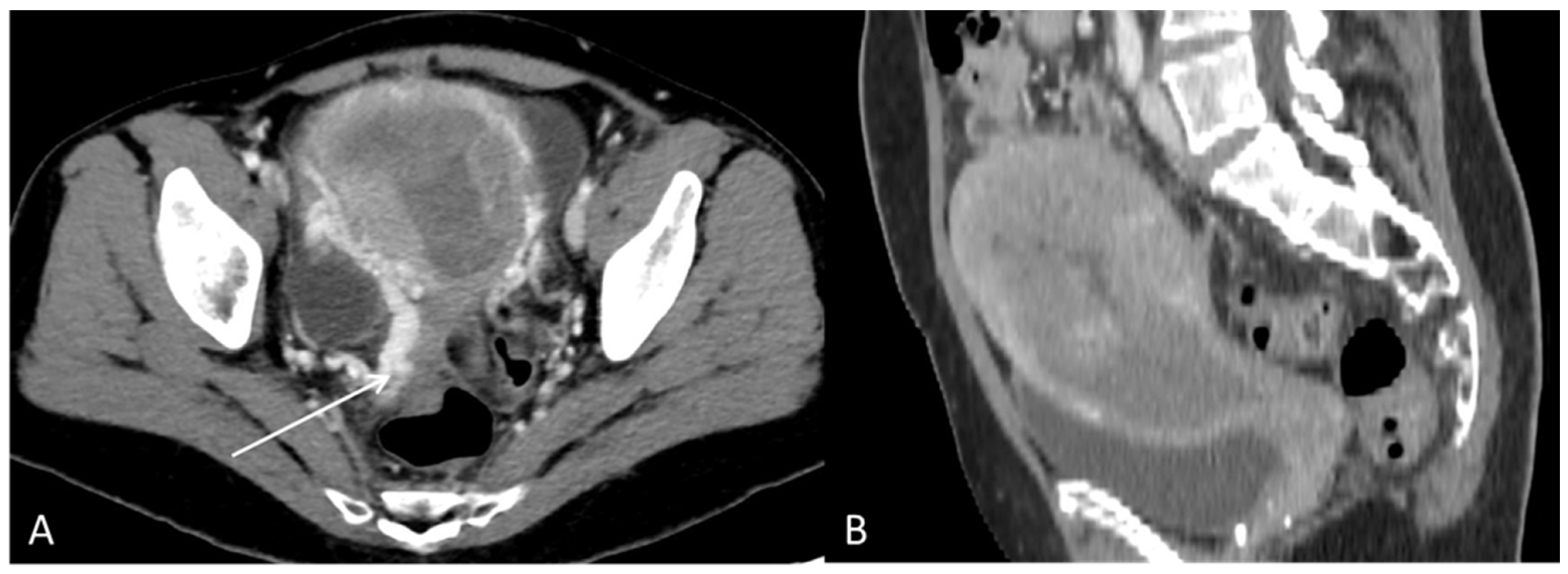 Disseminated Primary Uterine Hepatoid Adenocarcinoma with α-Fetoprotein ...