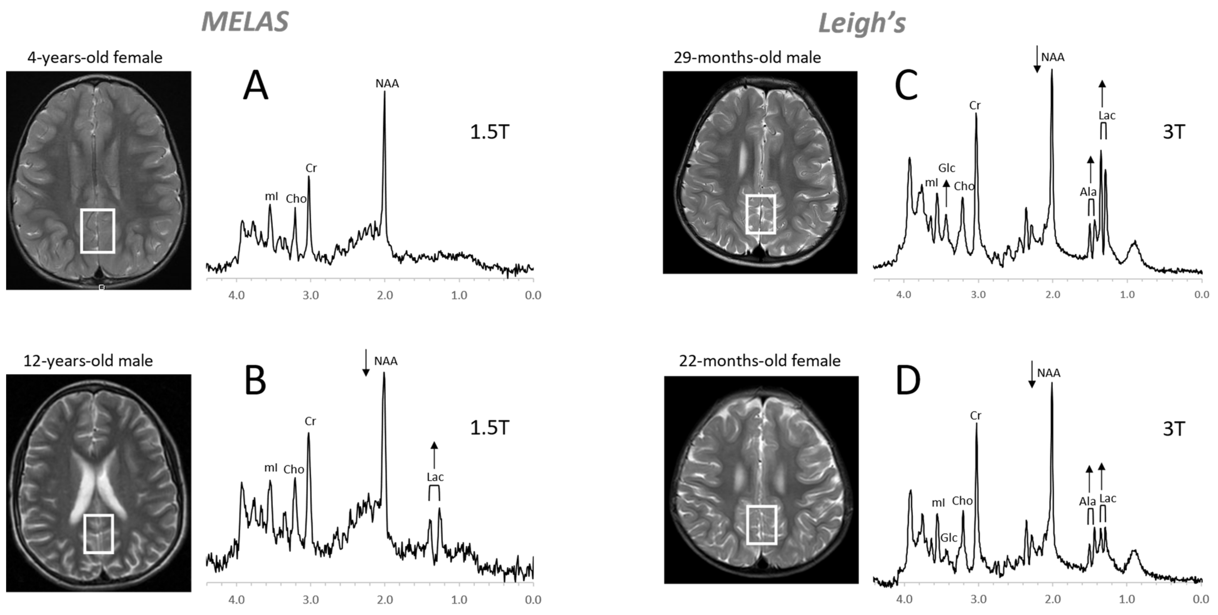 Diagnostics Free FullText Proton MR Spectroscopy of Pediatric