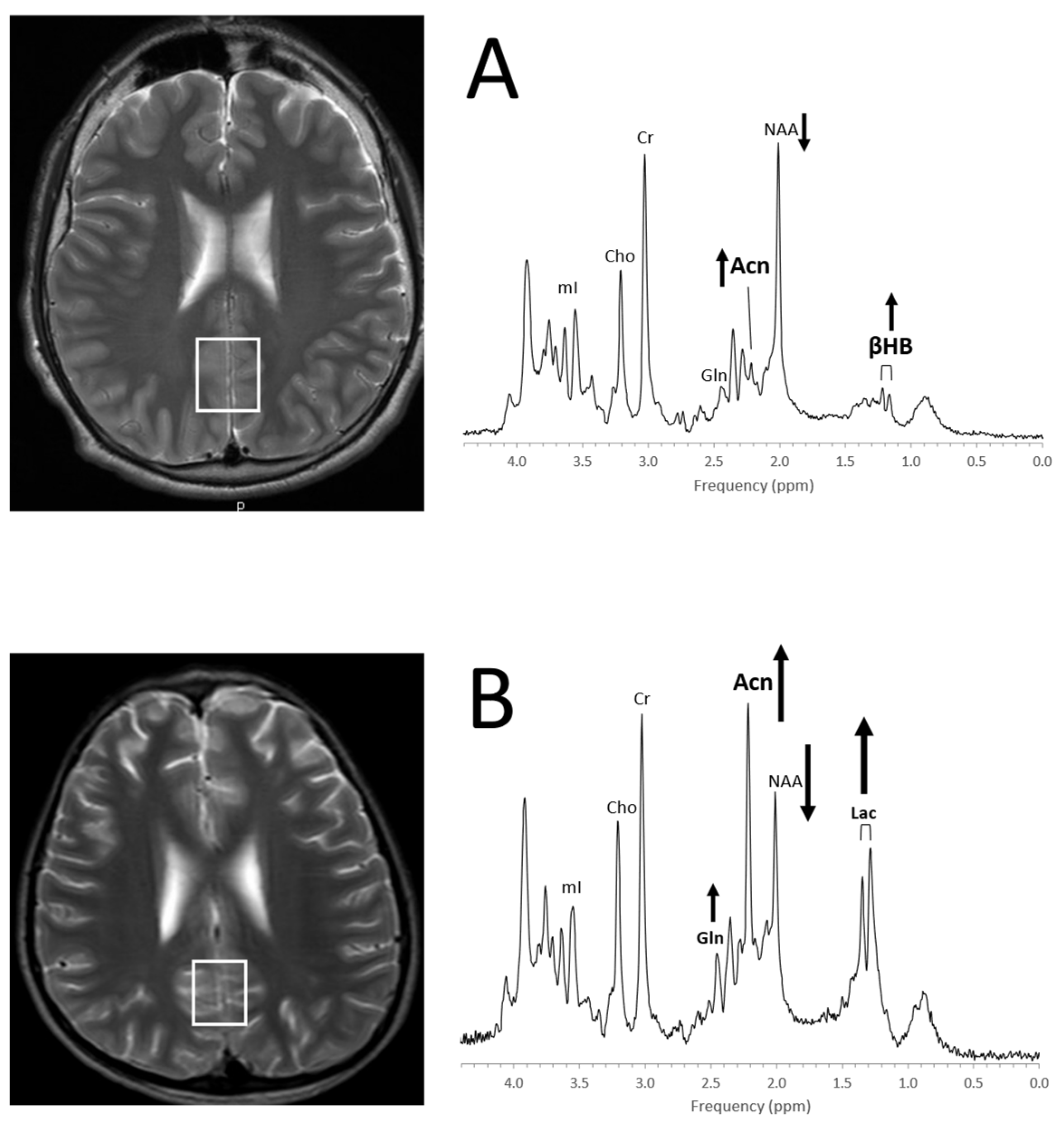 Diagnostics Free FullText Proton MR Spectroscopy of Pediatric Brain Disorders