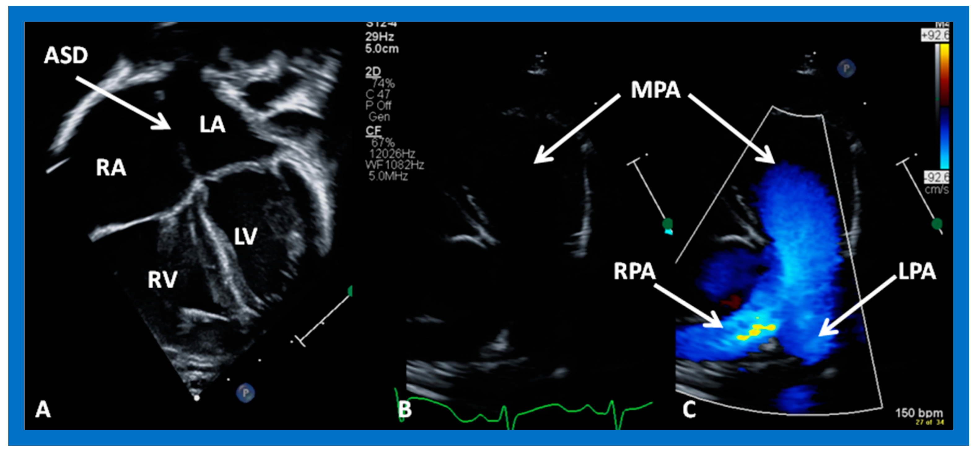 Transthoracic echocardiogram at admission and 6 mo follow up: global