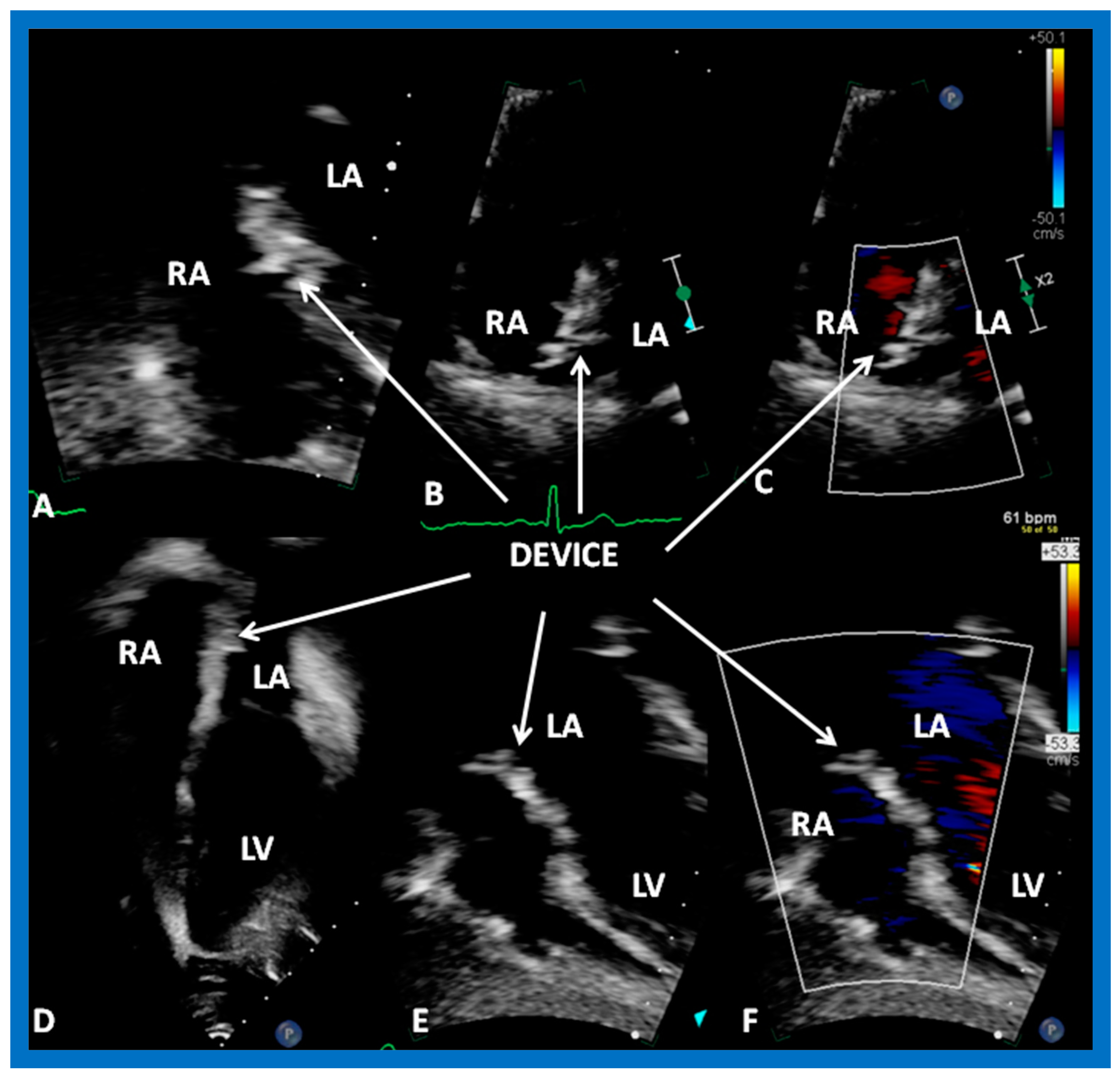 Diagnostics | Free Full-Text | Role of Echocardiography in the Diagnosis  and Interventional Management of Atrial Septal Defects | HTML