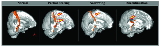Role of Diffusion Tensor Imaging in the Diagnosis of Traumatic Axonal ...