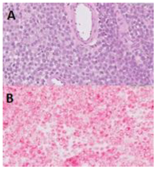 Liquid Biopsy with Detection of NRASQ61K Mutation in