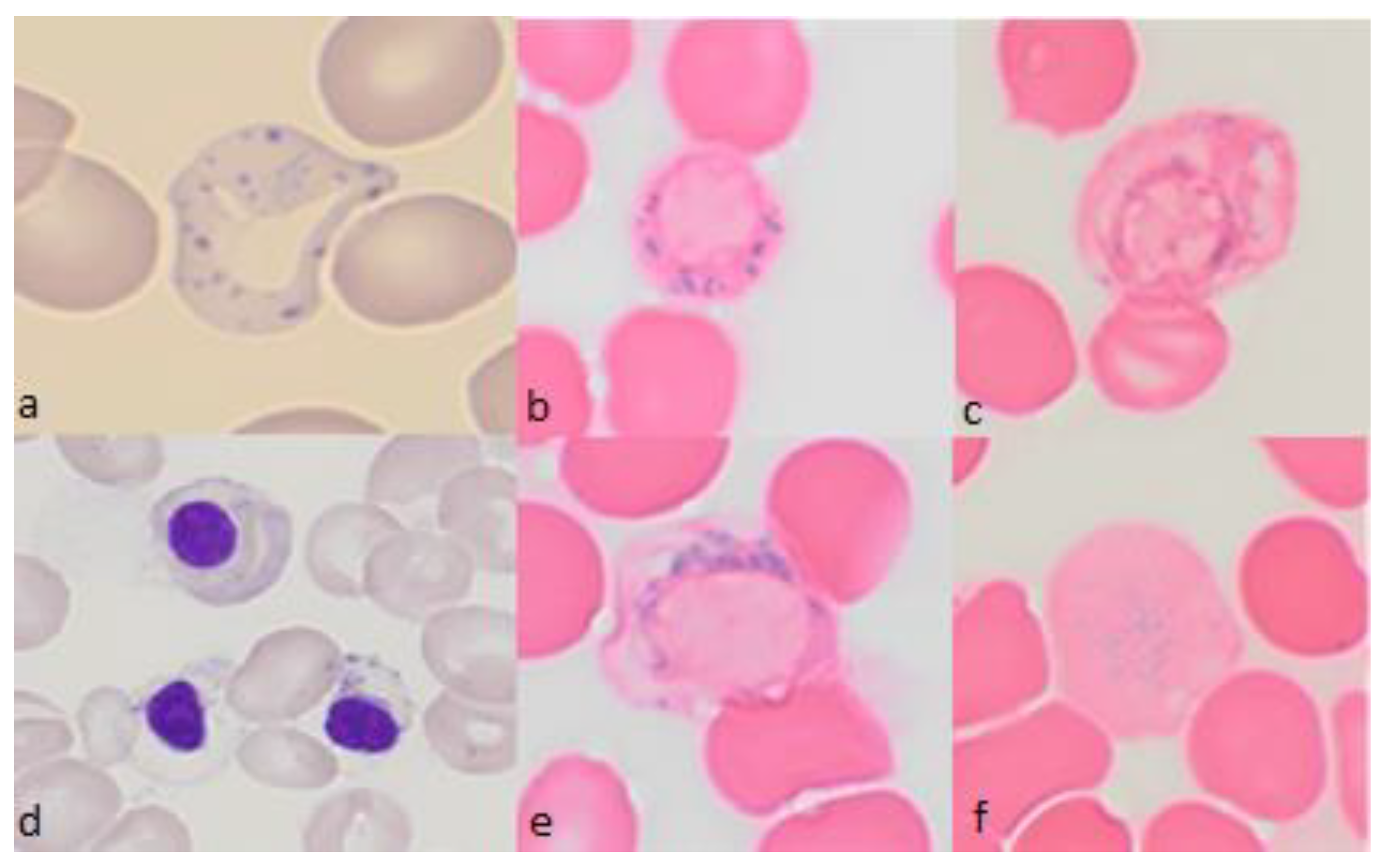 Diagnostics | Free Full-Text | When Ring Sideroblasts on Bone Marrow Smears  Are Inconsistent with the Diagnosis of Myelodysplastic Neoplasms