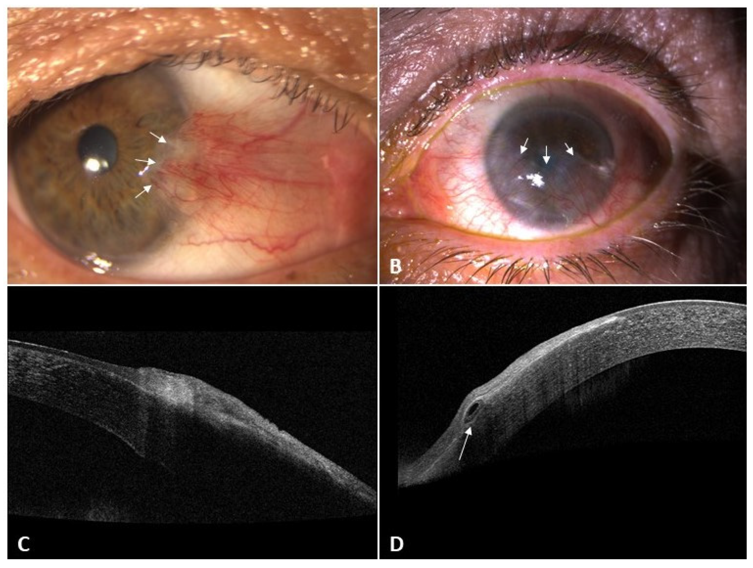 Diagnostics Free FullText Pseudopterygium An Algorithm Approach