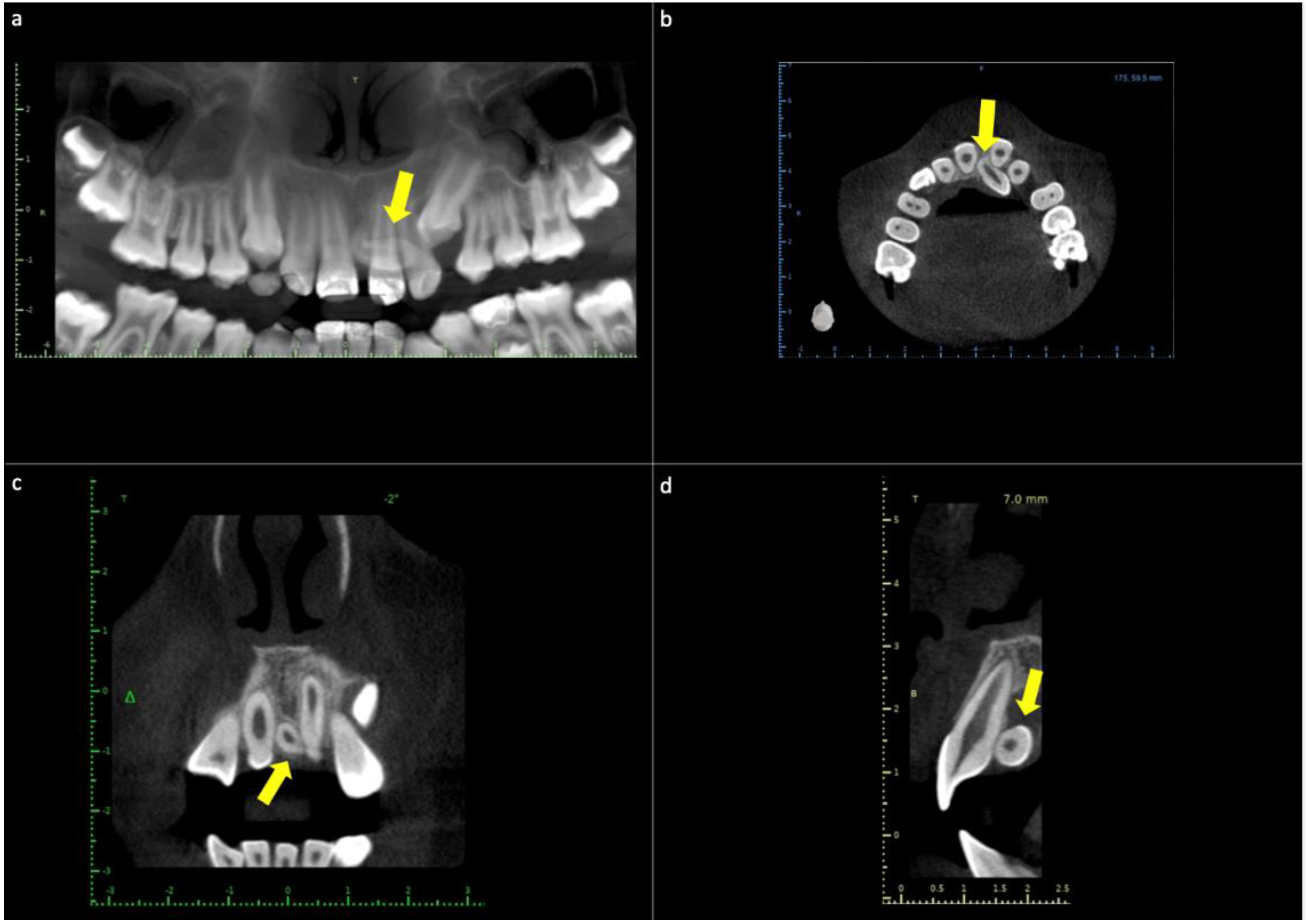 Diagnostics Free FullText NonSyndromic Familial Mesiodens