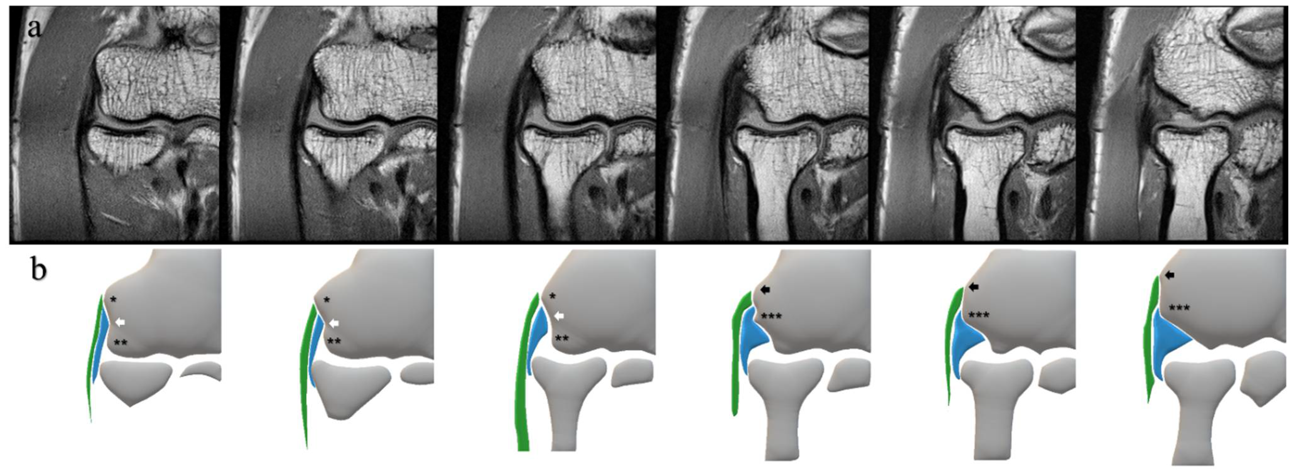 Diagnostics | Free Full-Text | Individual Evaluation of the Common Extensor  Tendon and Lateral Collateral Ligament Improves the Severity Diagnostic  Accuracy of Magnetic Resonance Imaging for Lateral Epicondylitis