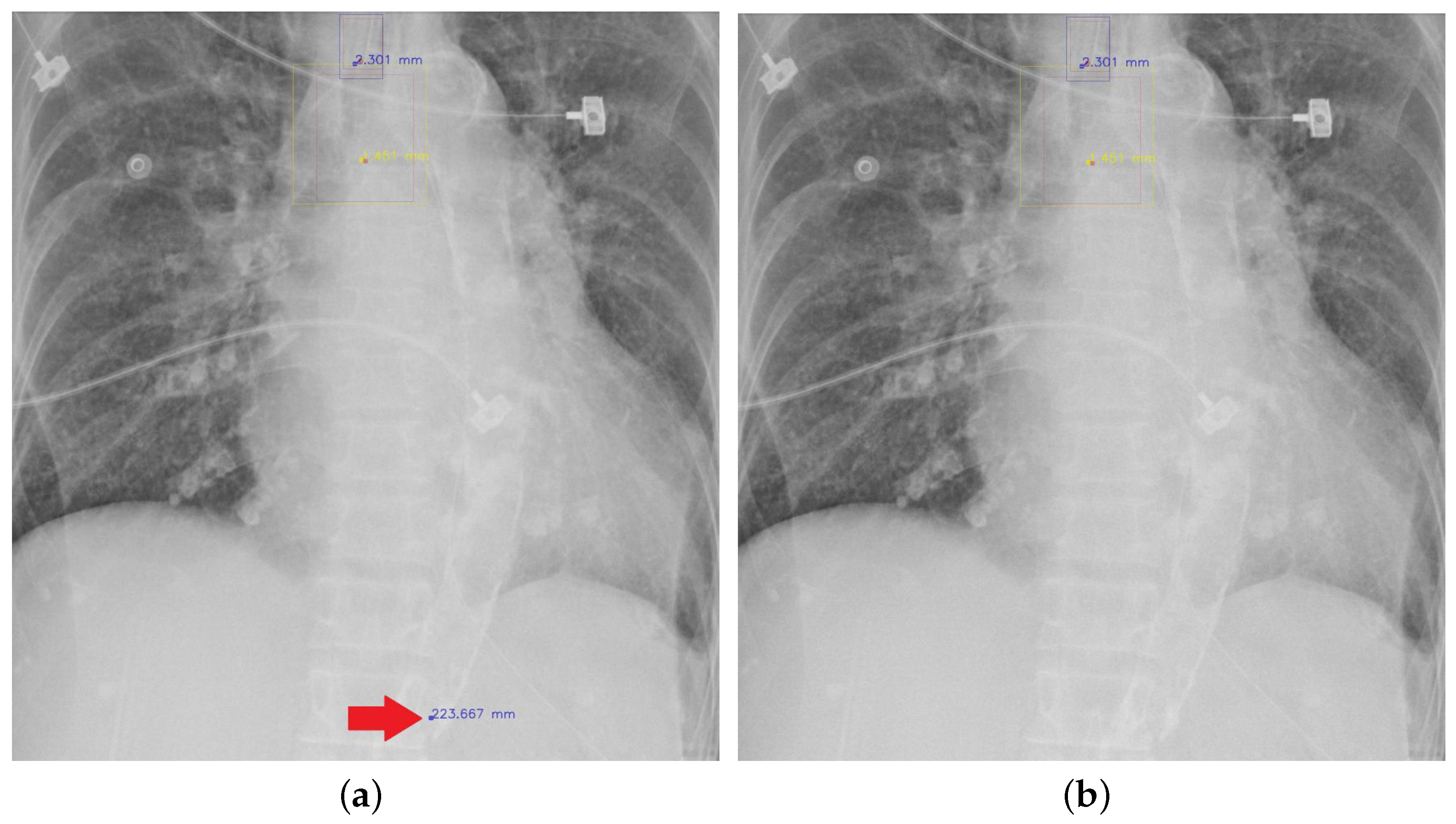 Diagnostics Free FullText Detecting Endotracheal Tube and Carina