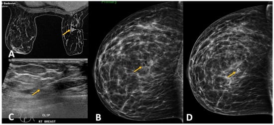 Tissue marker migration after MRI‐guided breast biopsy: Migration frequency  and associated factors - Funaro - 2020 - The Breast Journal - Wiley Online  Library