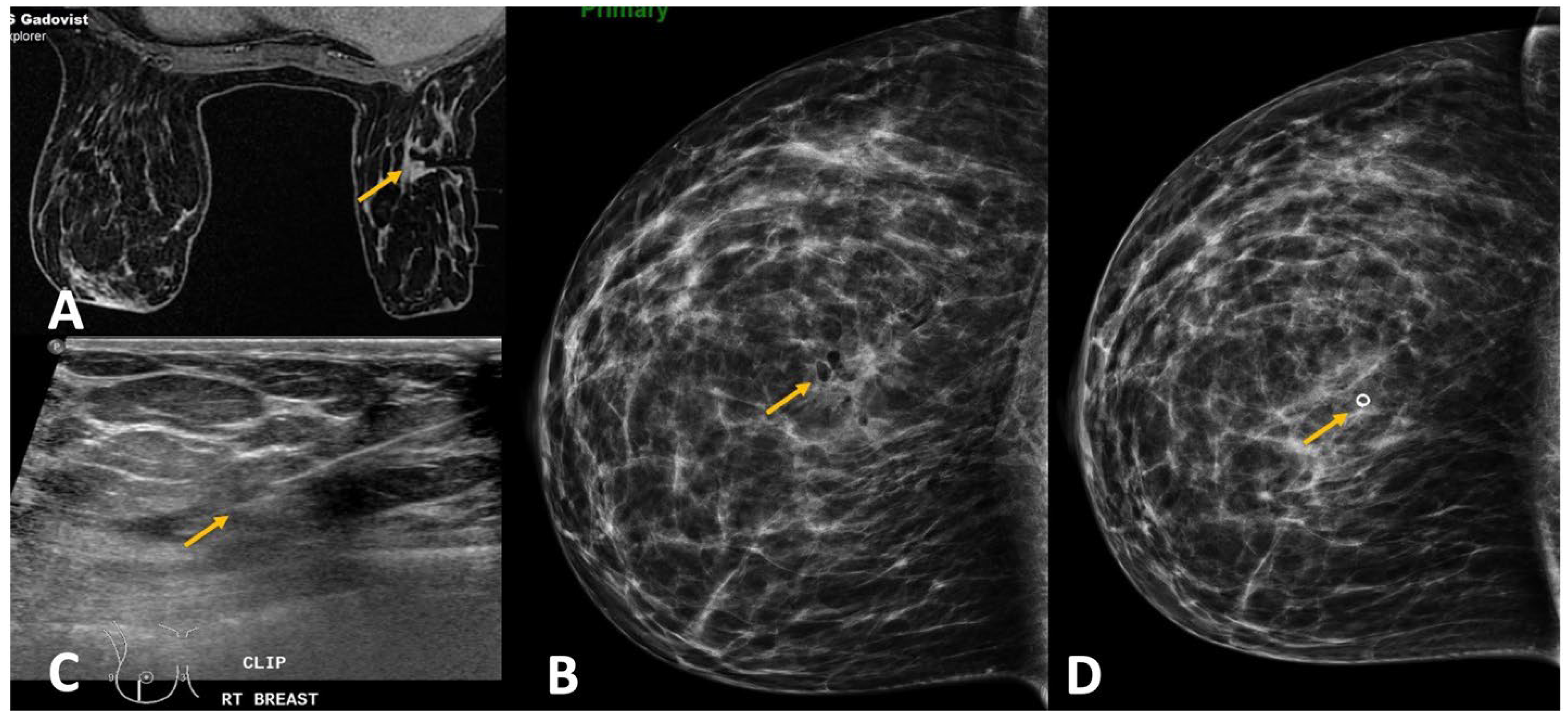 Diagnostics Free Full Text Challenges In MRI Guided Breast Biopsy stereotactic-breast-biopsy-ose-surgery-center