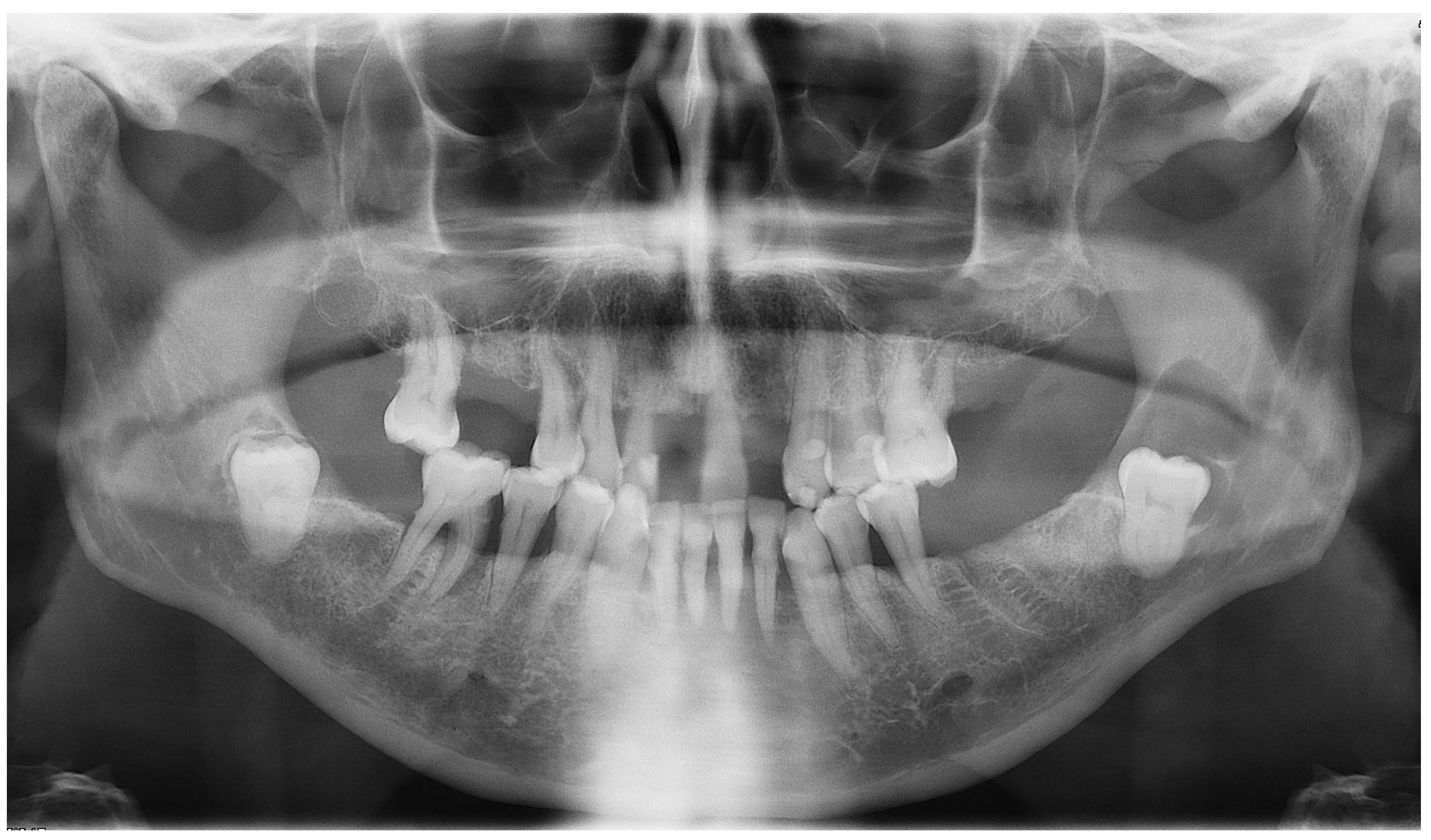 calcifying odontogenic cyst radiographic