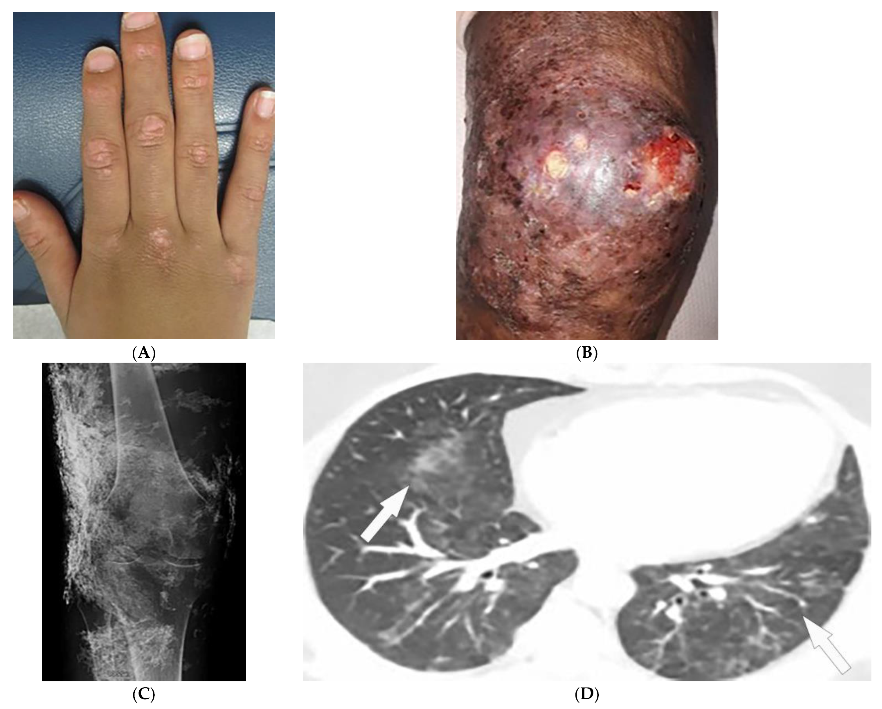 Pulmonary nodules in African migrants caused by chronic