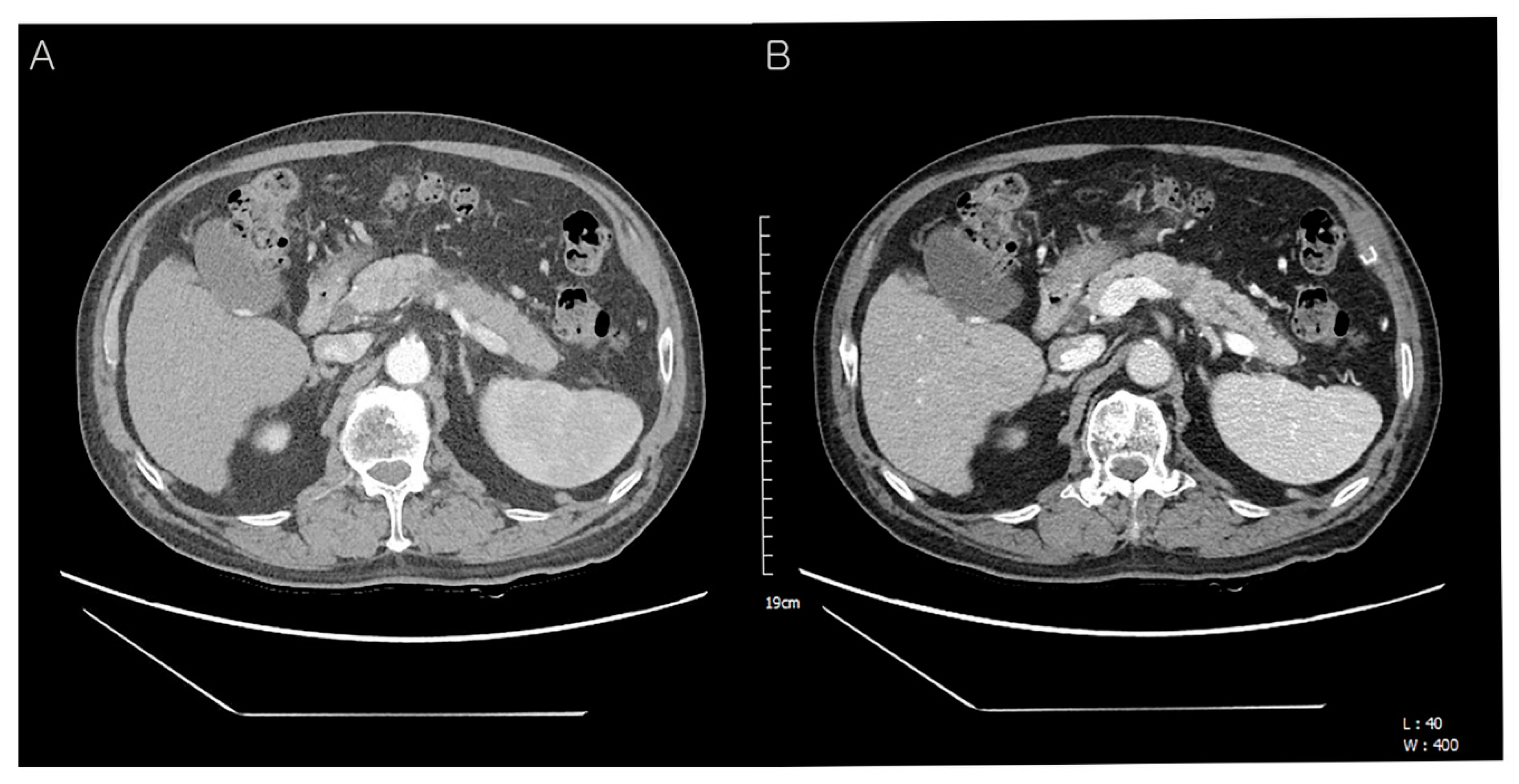 Primary Clear Cell Carcinoma of the Pancreas: A Rare Case Report Primary Clear Cell Carcinoma of the Pancreas: A Rare Case Report