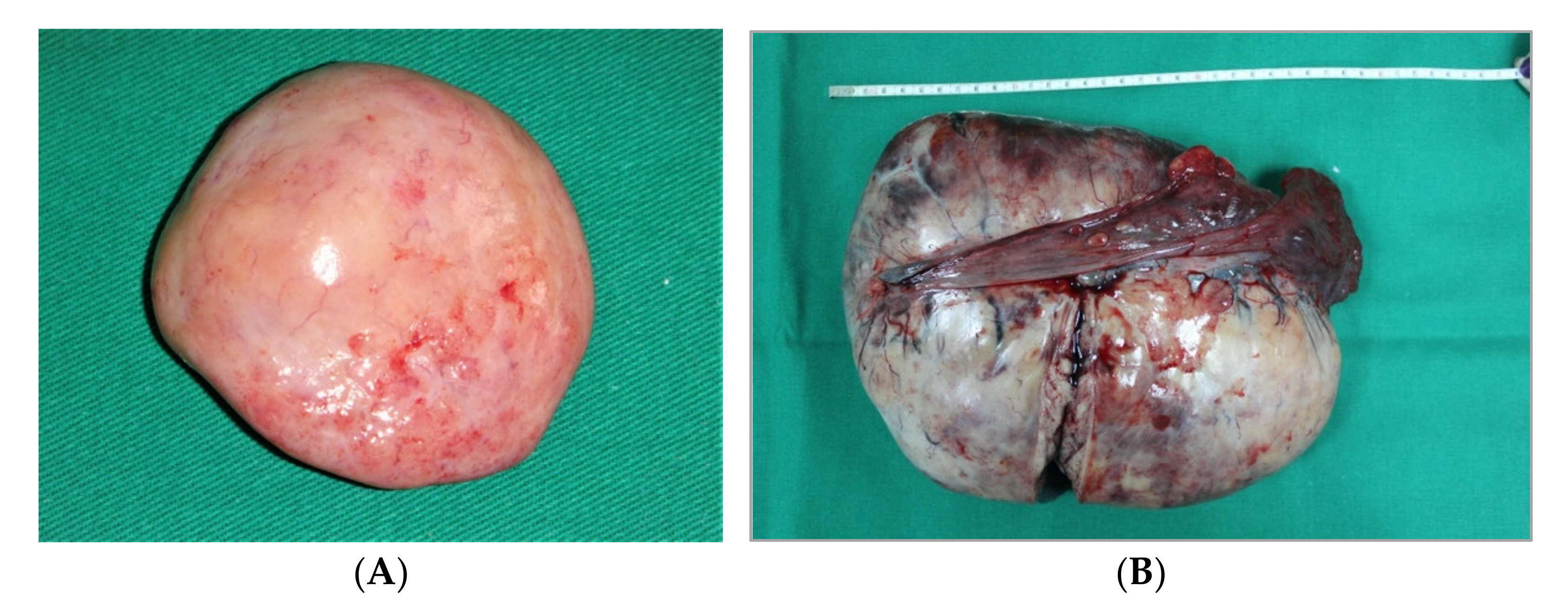 Diagnostics | Free Full-Text | Ovarian Germ Cell Tumors: Pictorial Essay Diagnostics | Free Full-Text | Ovarian Germ Cell Tumors: Pictorial Essay