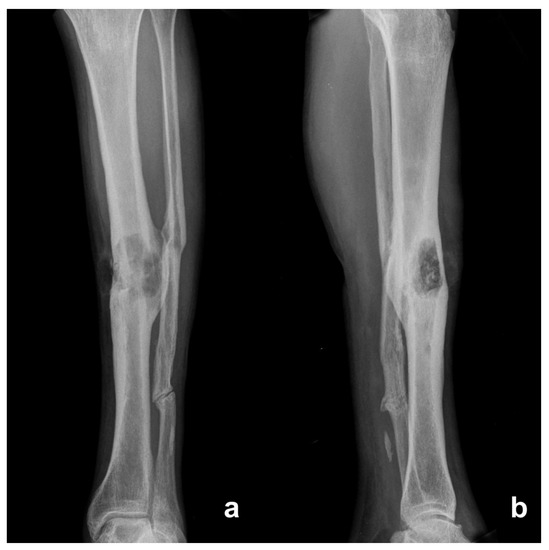 Diagnostics Free FullText Management of Squamous Cell Carcinoma in