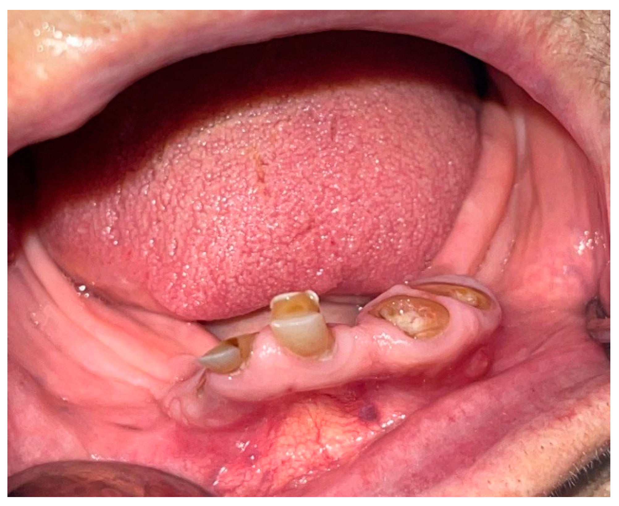 canker sore on cheek near wisdom tooth