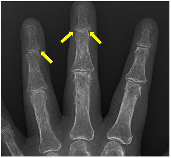 Diagnostics Free FullText Radiographic Findings of Inflammatory