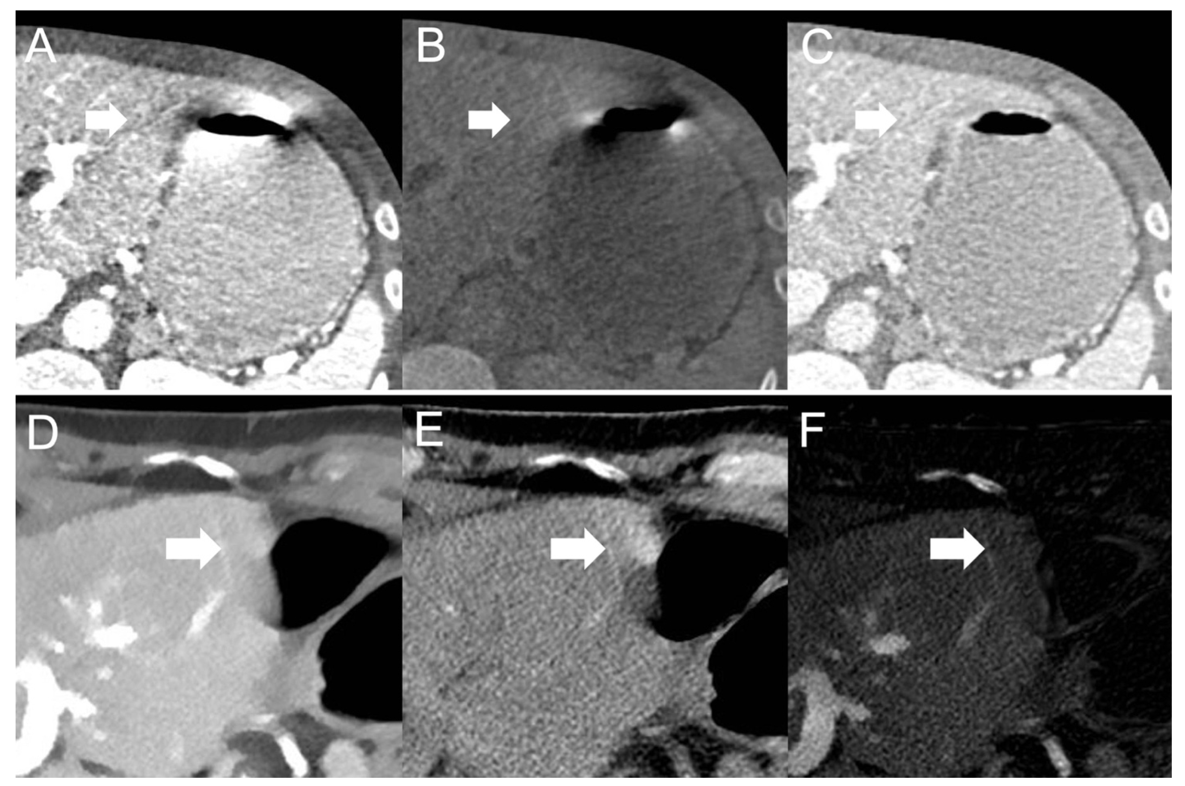 Reducing VisceralMotionRelated Artifacts on the Liver with Dual