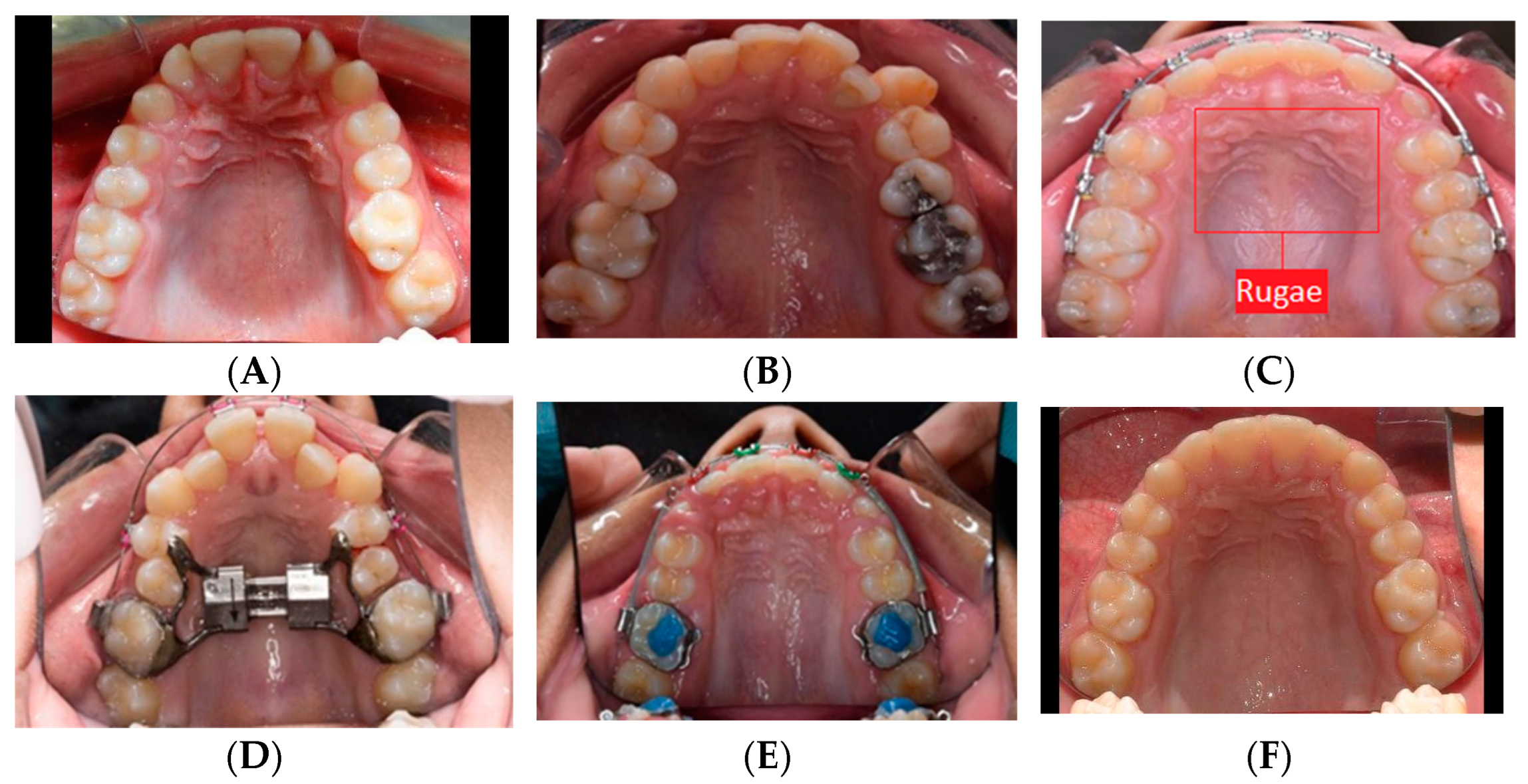 Diagnostics Free FullText Semantic Segmentation of Maxillary Teeth