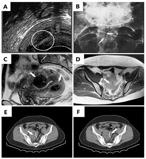Diagnostics Free FullText An Interesting Image of Transmural
