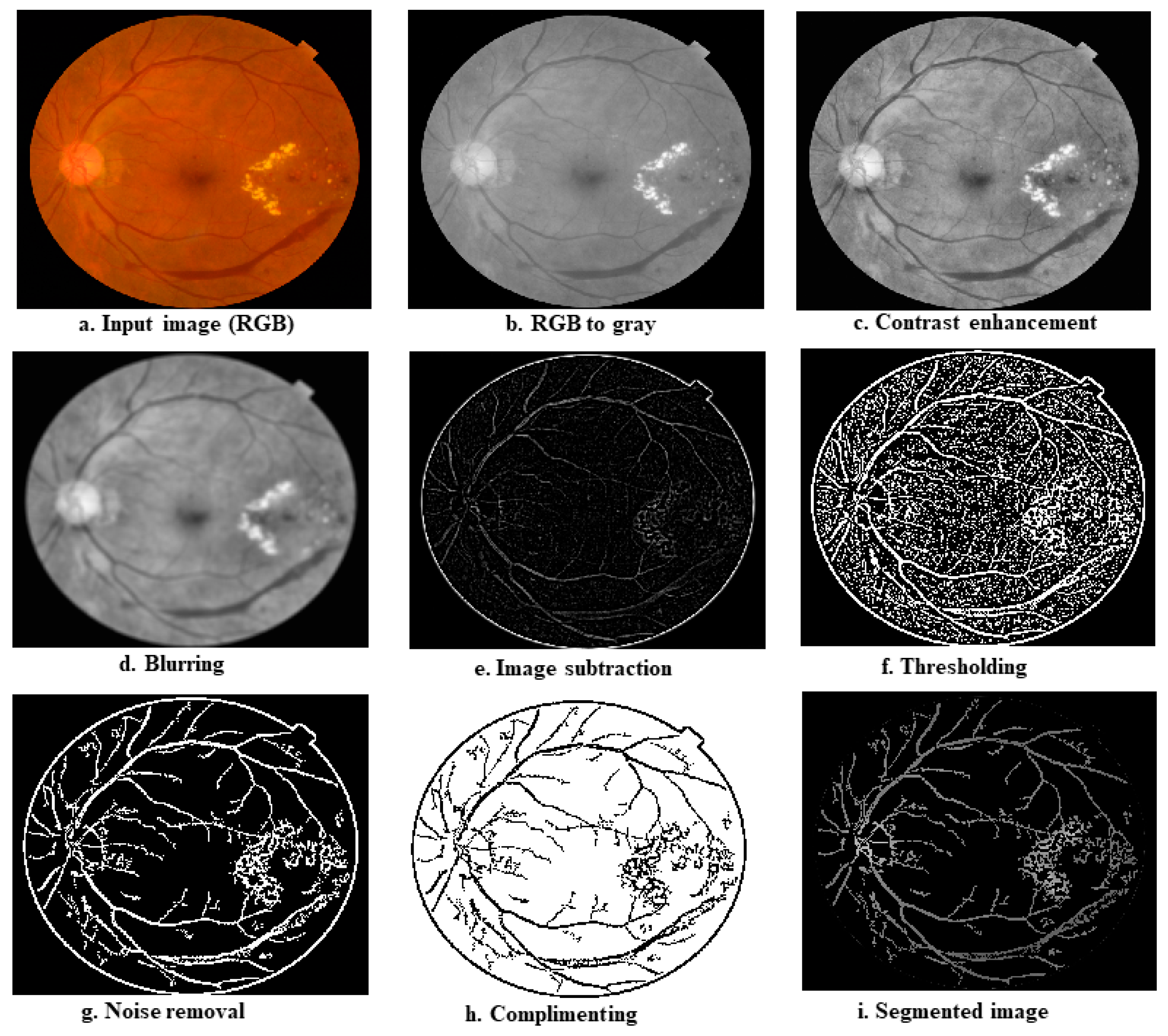 Automatic Screening of Diabetic Retinopathy Using Fundus Images and ...