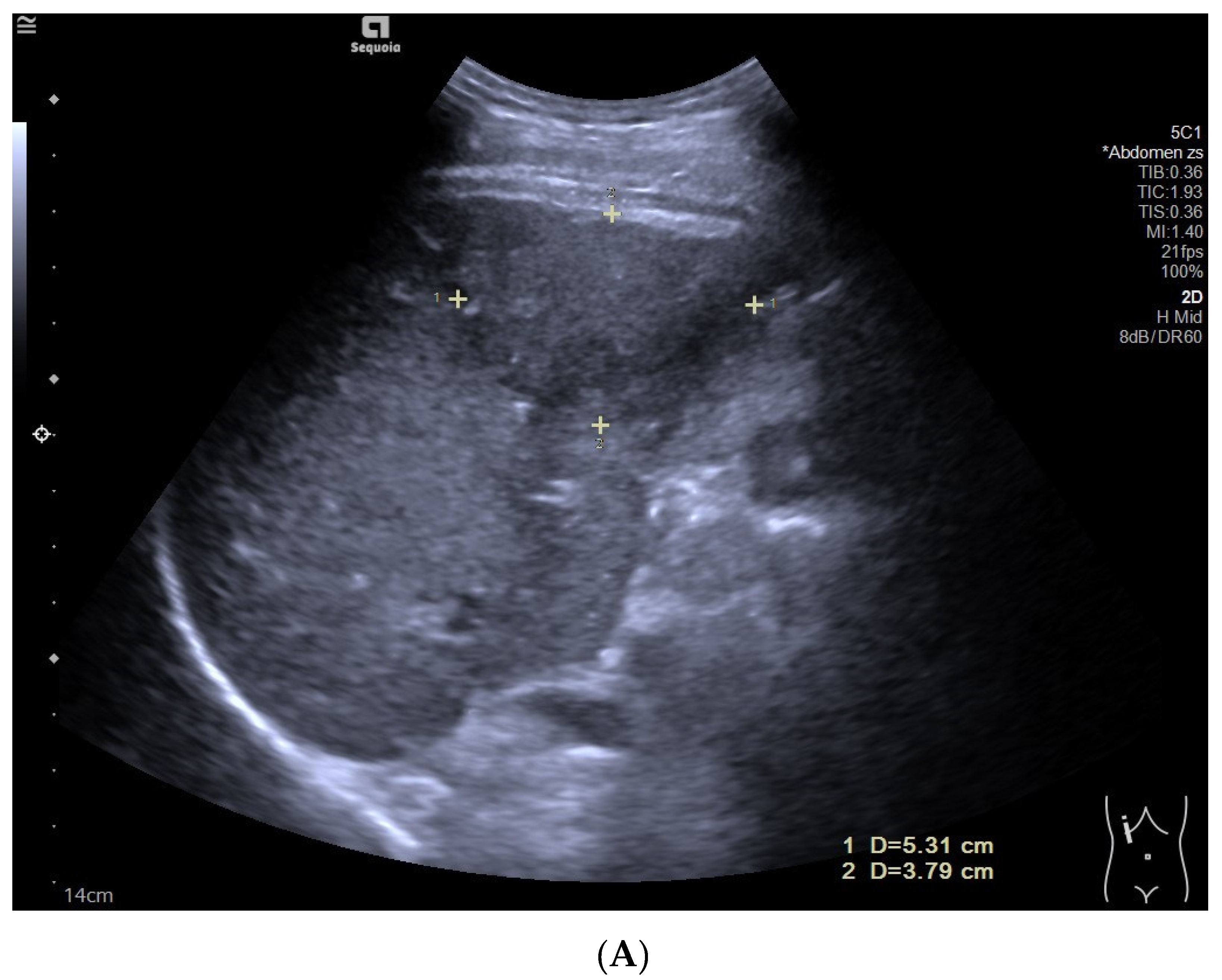 フィリップス、「Liver Fat Quantification（肝脂肪化定量評価