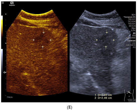 フィリップス、「Liver Fat Quantification（肝脂肪化定量評価