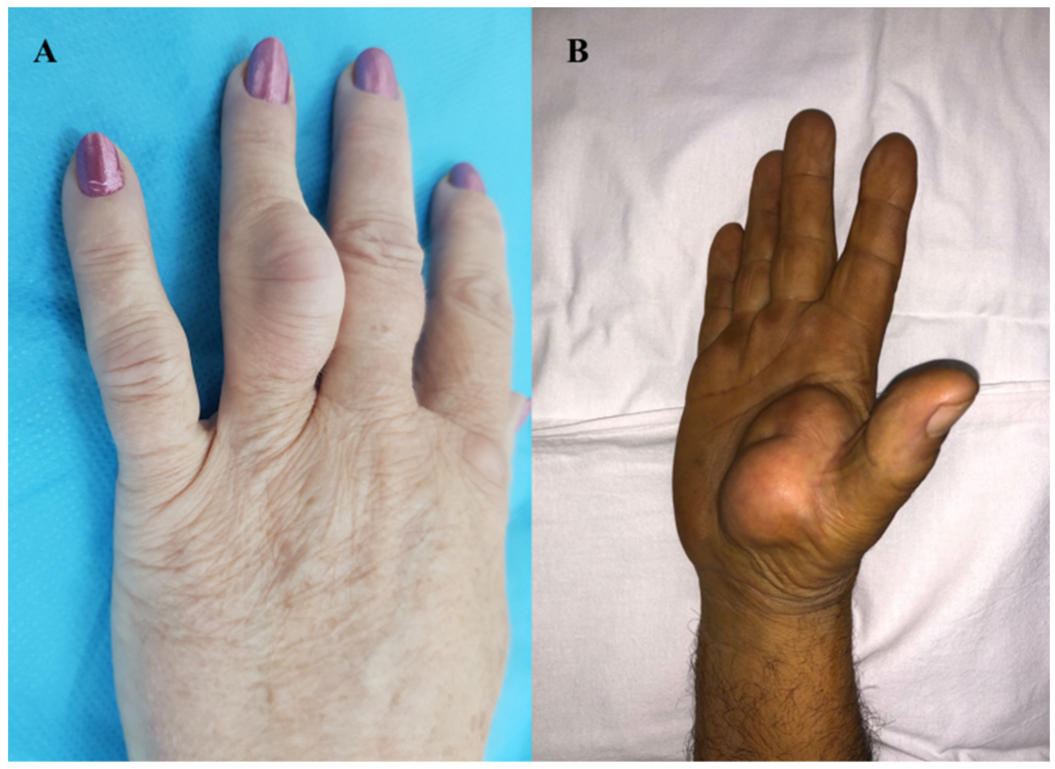 Diagnostics Free Full Text Atypical Sites Of The Lipoma On The Hand diagnostics-free-full-text-atypical-sites-of-the-lipoma-on-the-hand