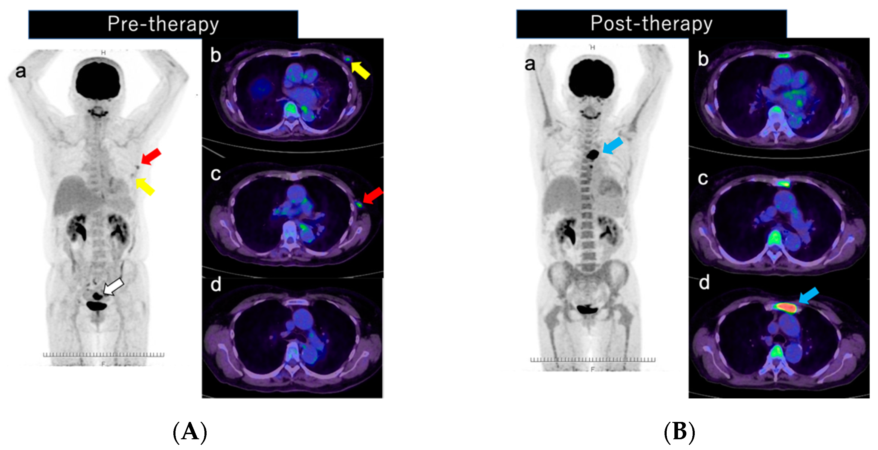 Diagnostics Free Full Text Focal Uptake In The Sternum On 18F FDG diagnostics-free-full-text-focal-uptake-in-the-sternum-on-18f-fdg