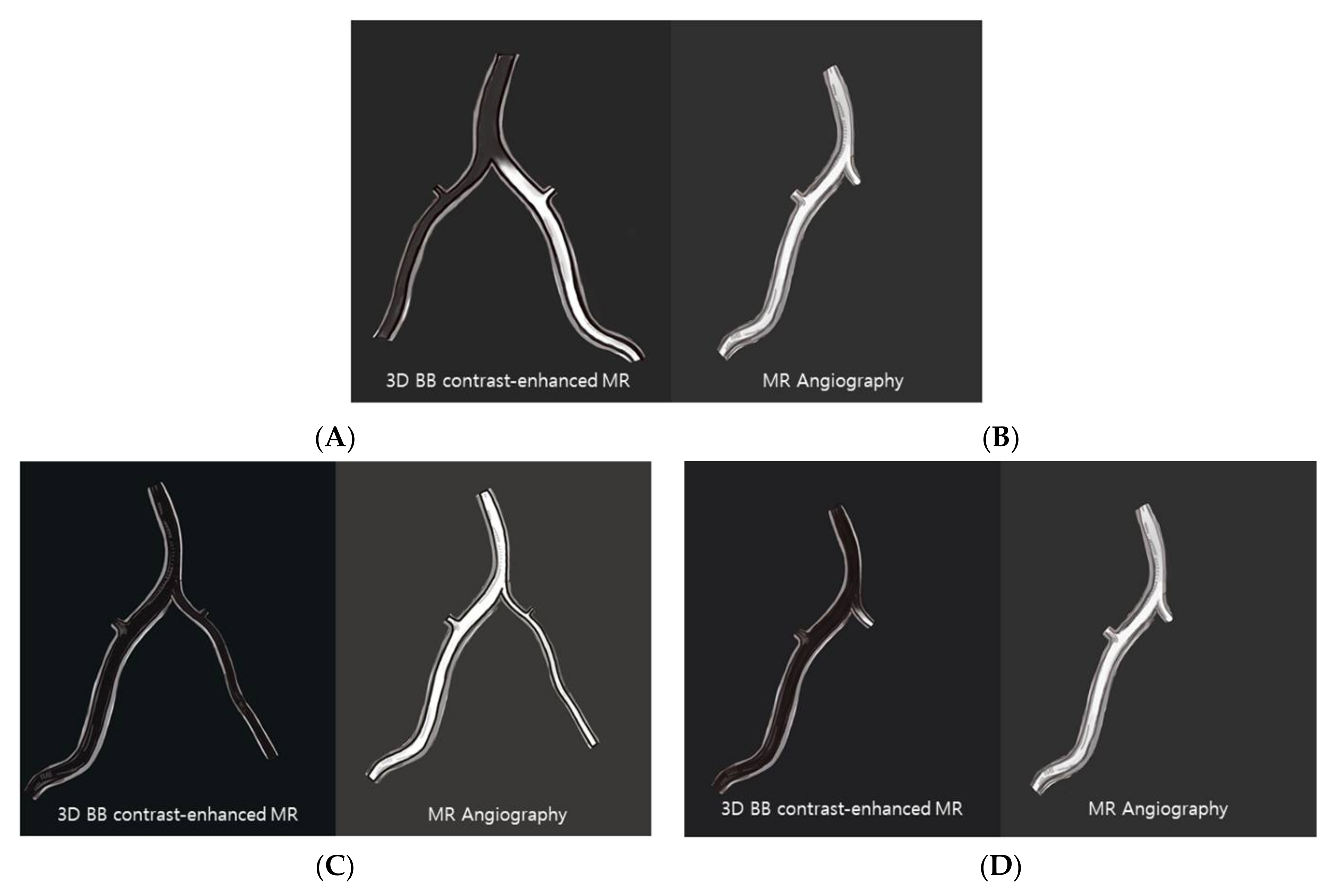 Diagnostics Free FullText Acute Distal Vertebral Artery Occlusion