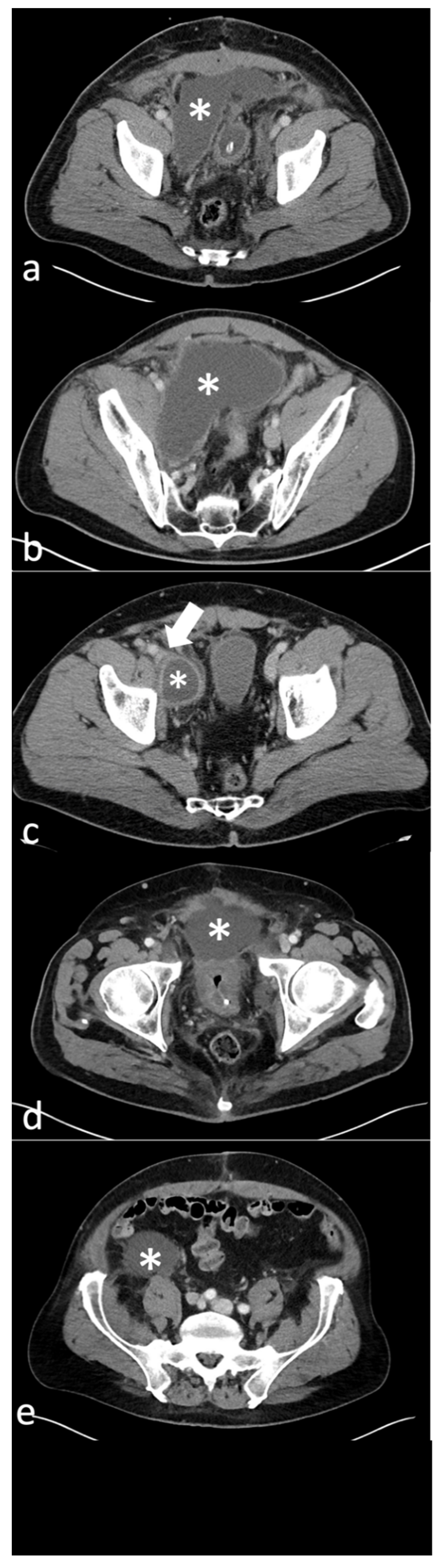 Diagnostics Free Full Text Technical Outcome Clinical Success And Complications Of Low Milliampere Computed Tomography Fluoroscopy Guided Drainage Of Lymphoceles Following Radical Prostatectomy With Pelvic Lymph Node Dissection
