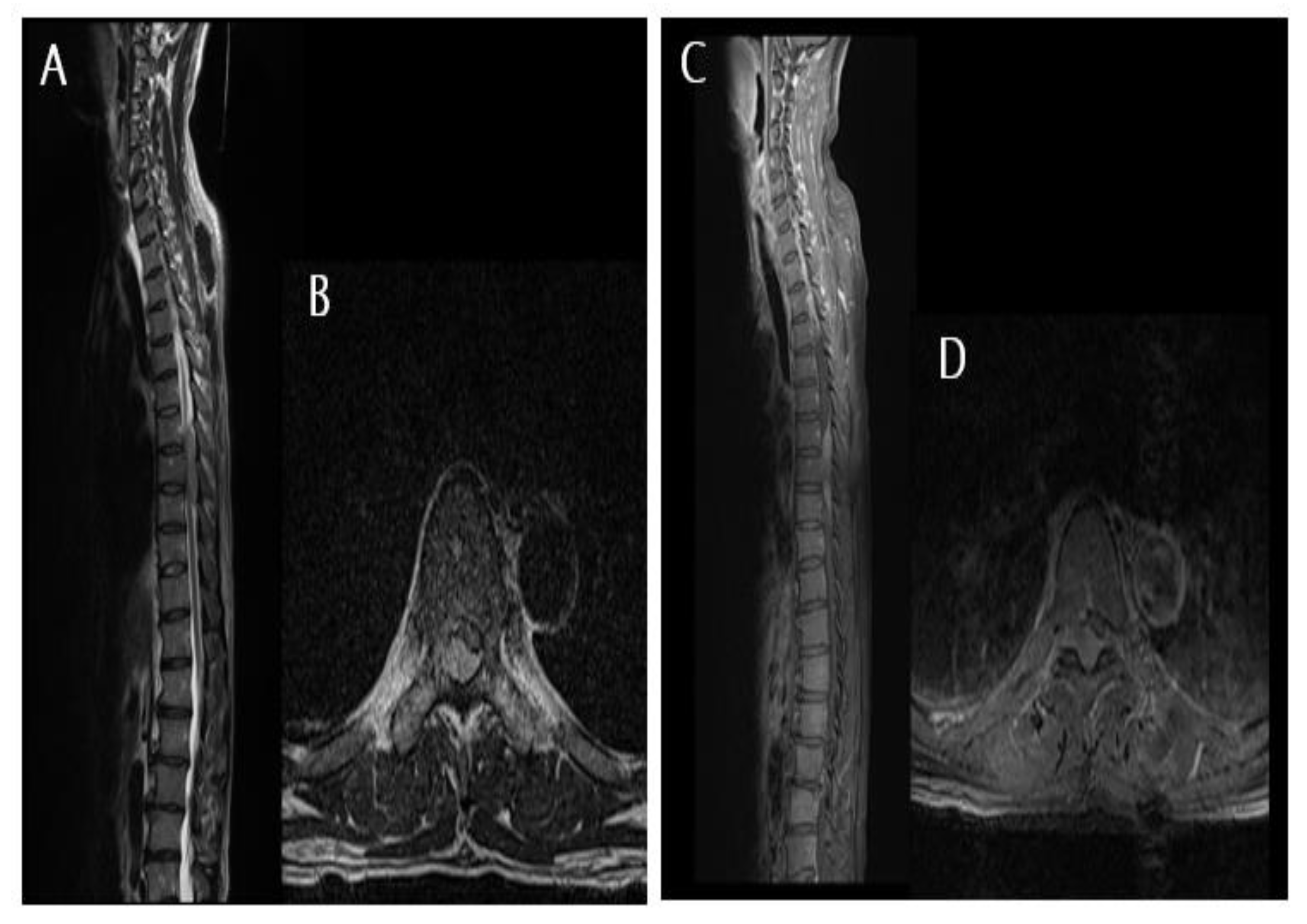 primary-malignant-lymphoma-presenting-as-an-isolated-epidural-mass