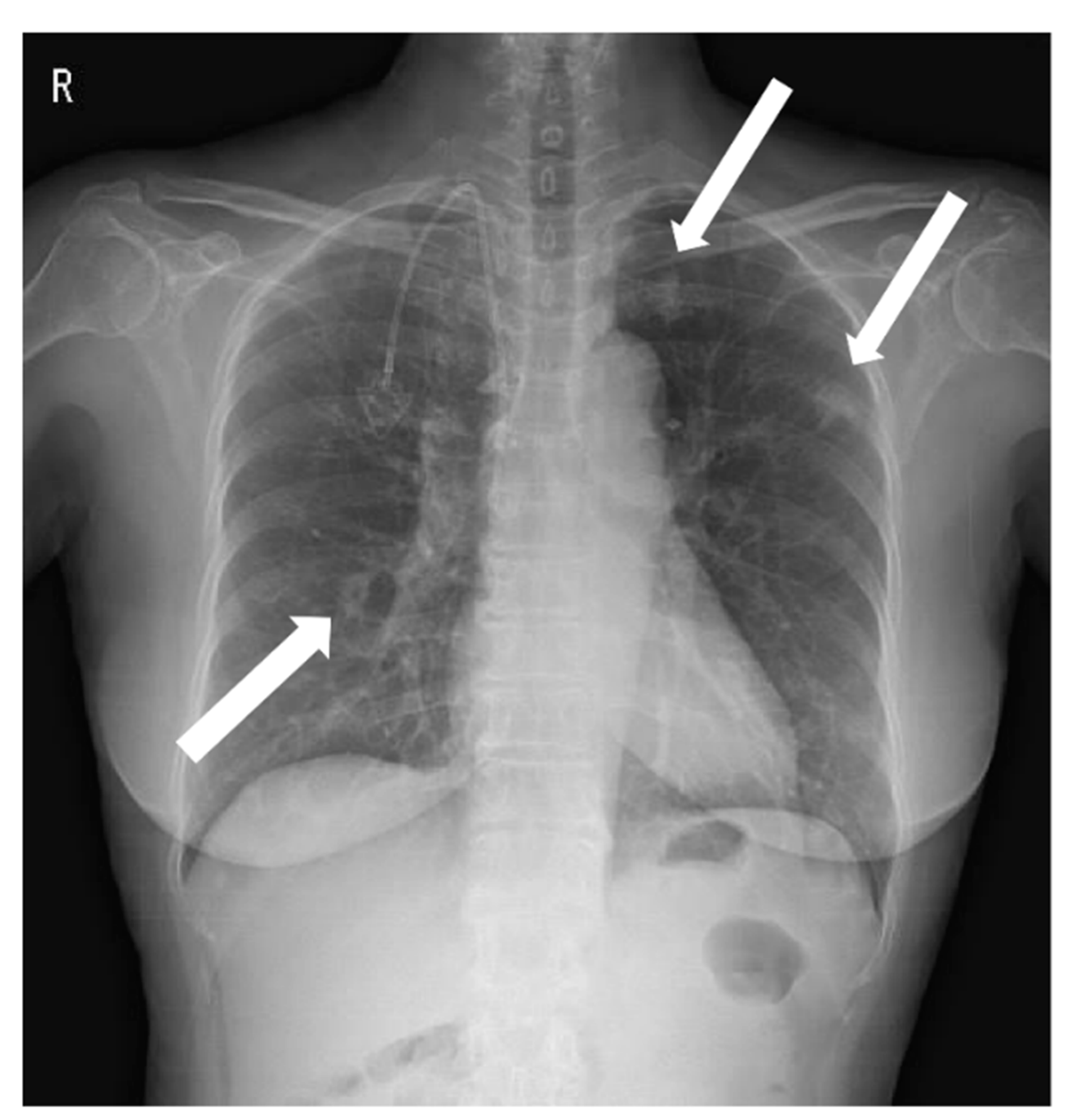 Diagnostics Free FullText Septic Pulmonary Emboli Detected by 18F
