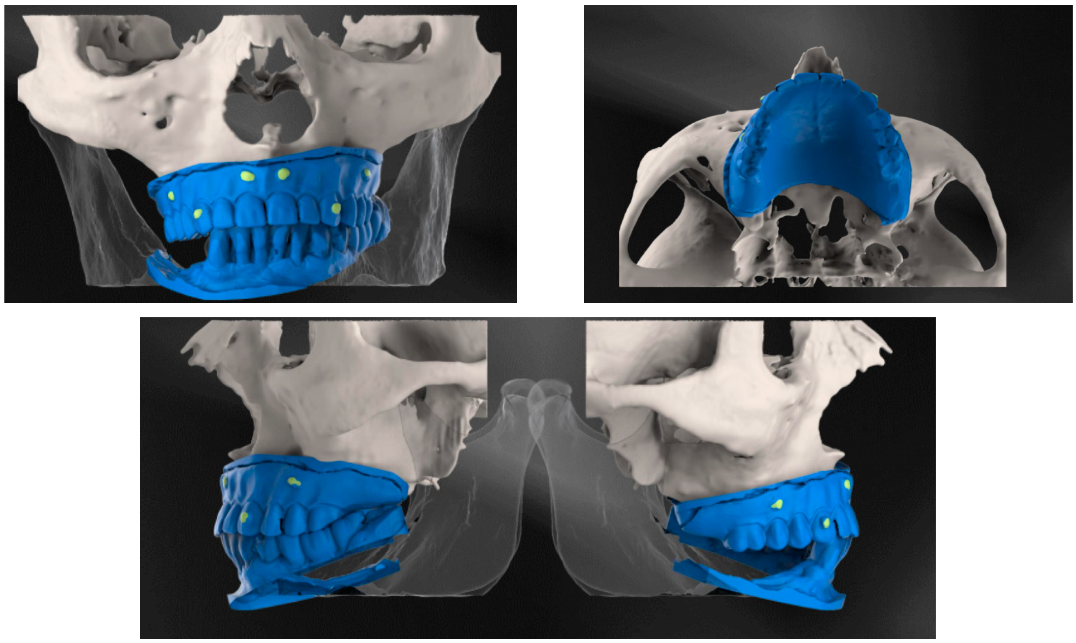 Diagnostics | Free Full-Text | Custom-Made Direct Metal Laser Sintering Titanium Subperiosteal Implants in Oral and Maxillofacial Surgery for Severe Bone-Deficient Patients—A Pilot Study Diagnostics | Free Full-Text | Custom-Made Direct Metal Laser Sintering Titanium Subperiosteal Implants in Oral and Maxillofacial Surgery for Severe Bone-Deficient Patients—A Pilot Study
