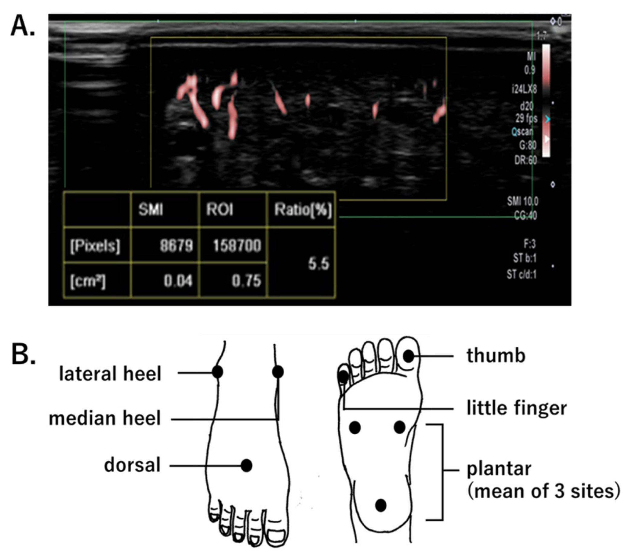 Diagnostics Free FullText Utility of Superb Microvascular Imaging