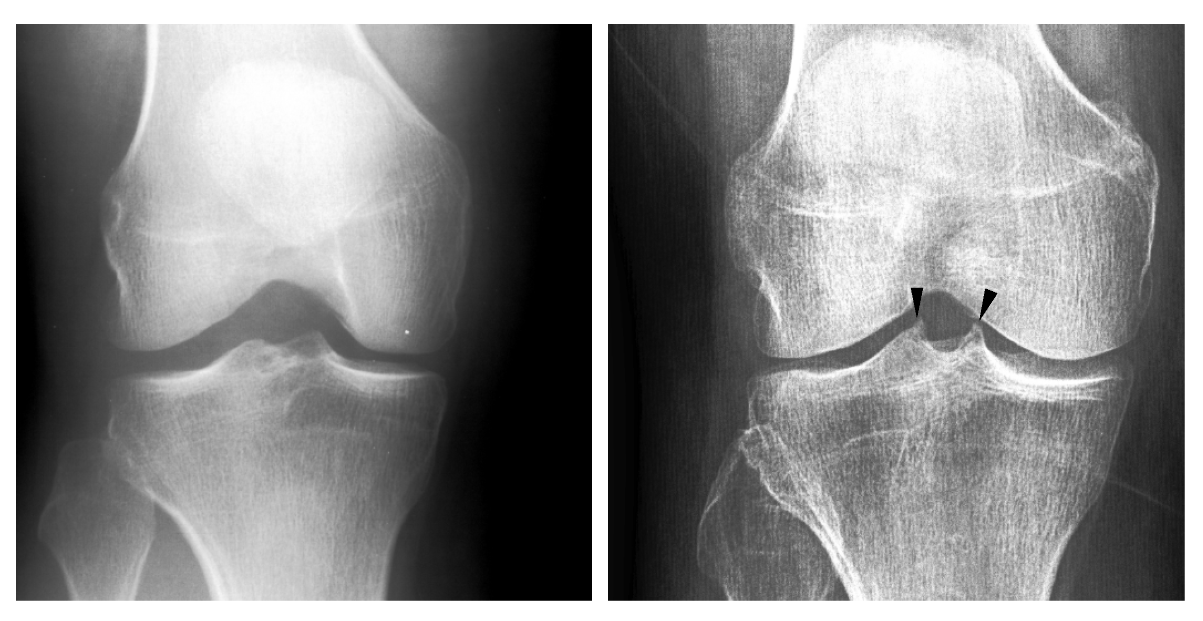 White Lines On Knee X Ray At Joan Nakashima Blog