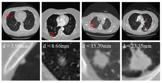 A Lower False Positive Pulmonary Nodule Detection Approach for Early ...
